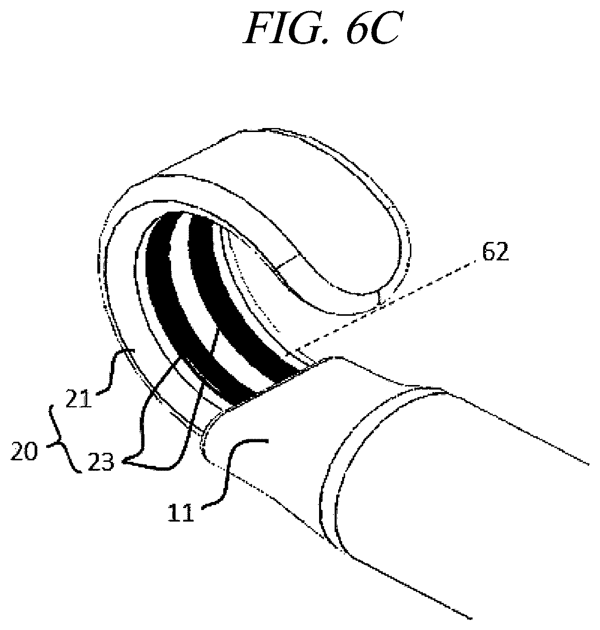 Patent US12599425 Figure 9 – Systems for perivascular nerve denervation