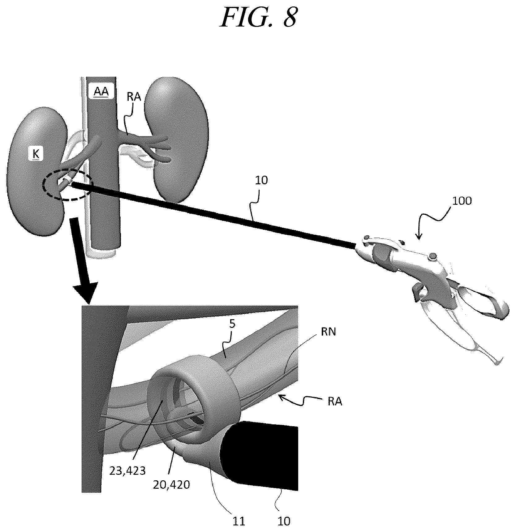 Patent US12599425 Figure 15 – Systems for perivascular nerve denervation