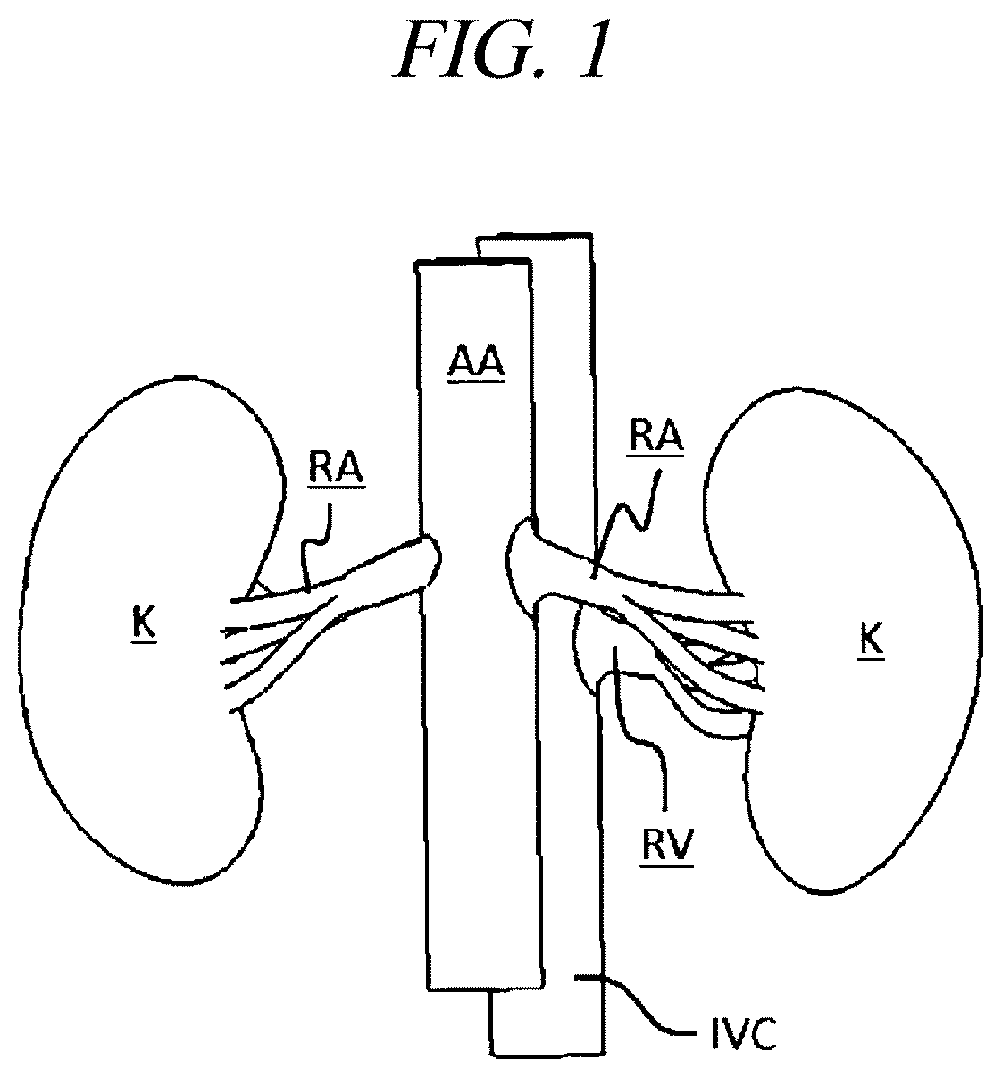 Patent US12599430 — Systems and methods for perivascular nerve denervation — Figure 1