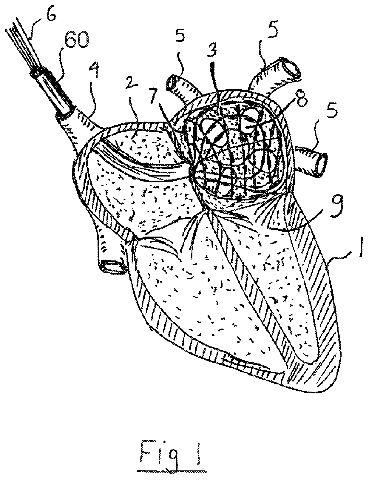 Patent US12599433 — Apparatus and method for intra-cardiac mapping and ablation — Figure 1
