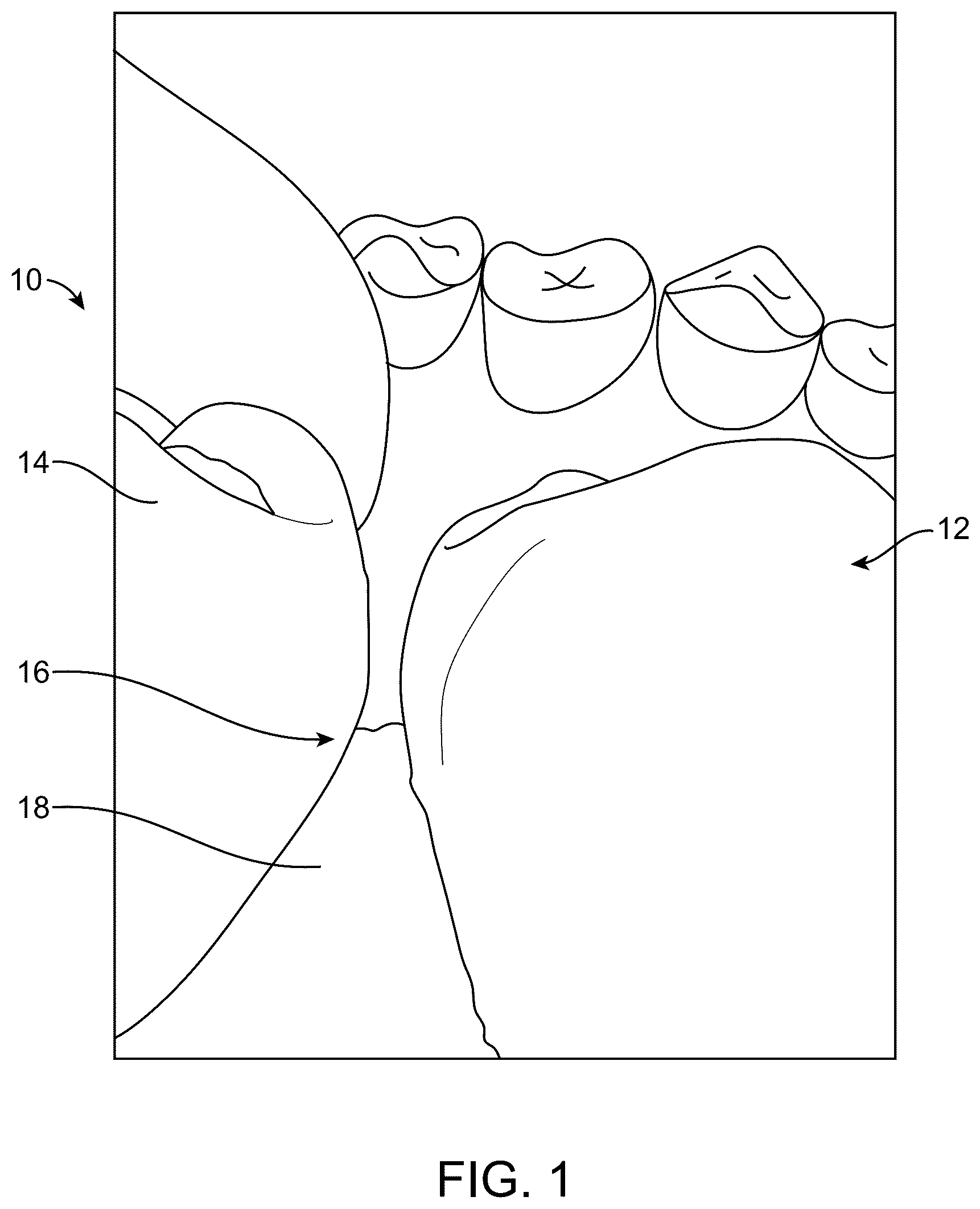Patent US12599460 — Device for placement in interdental resin fillings — Figure 1