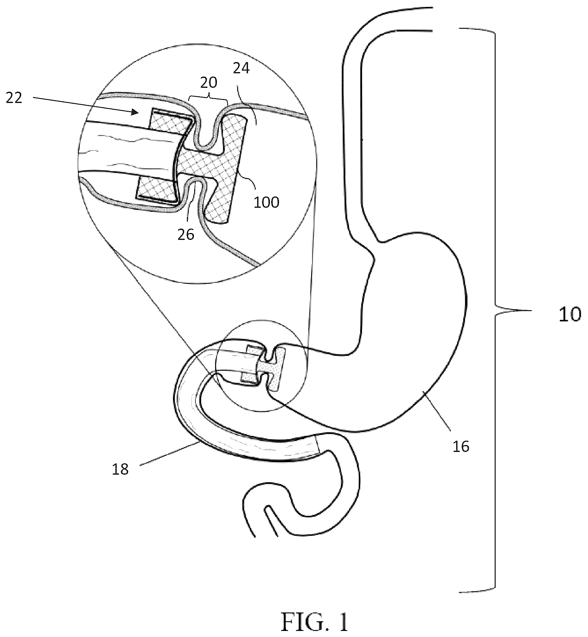 Patent US12599469 — Systems and methods for anchoring and restraining gastrointestinal prostheses — Figure 1