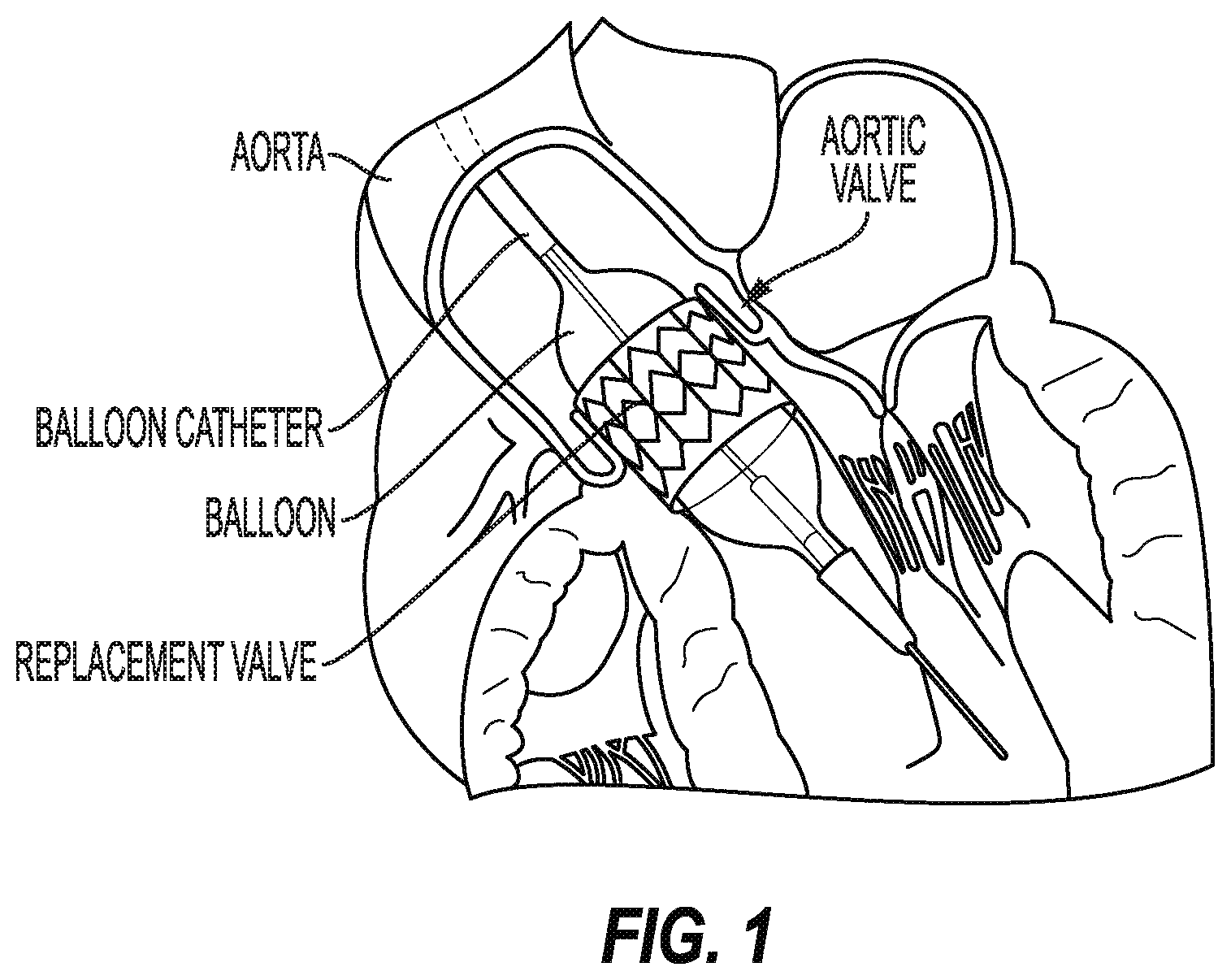 Patent US12599471 — Expandable devices and associated systems and methods — Figure 1