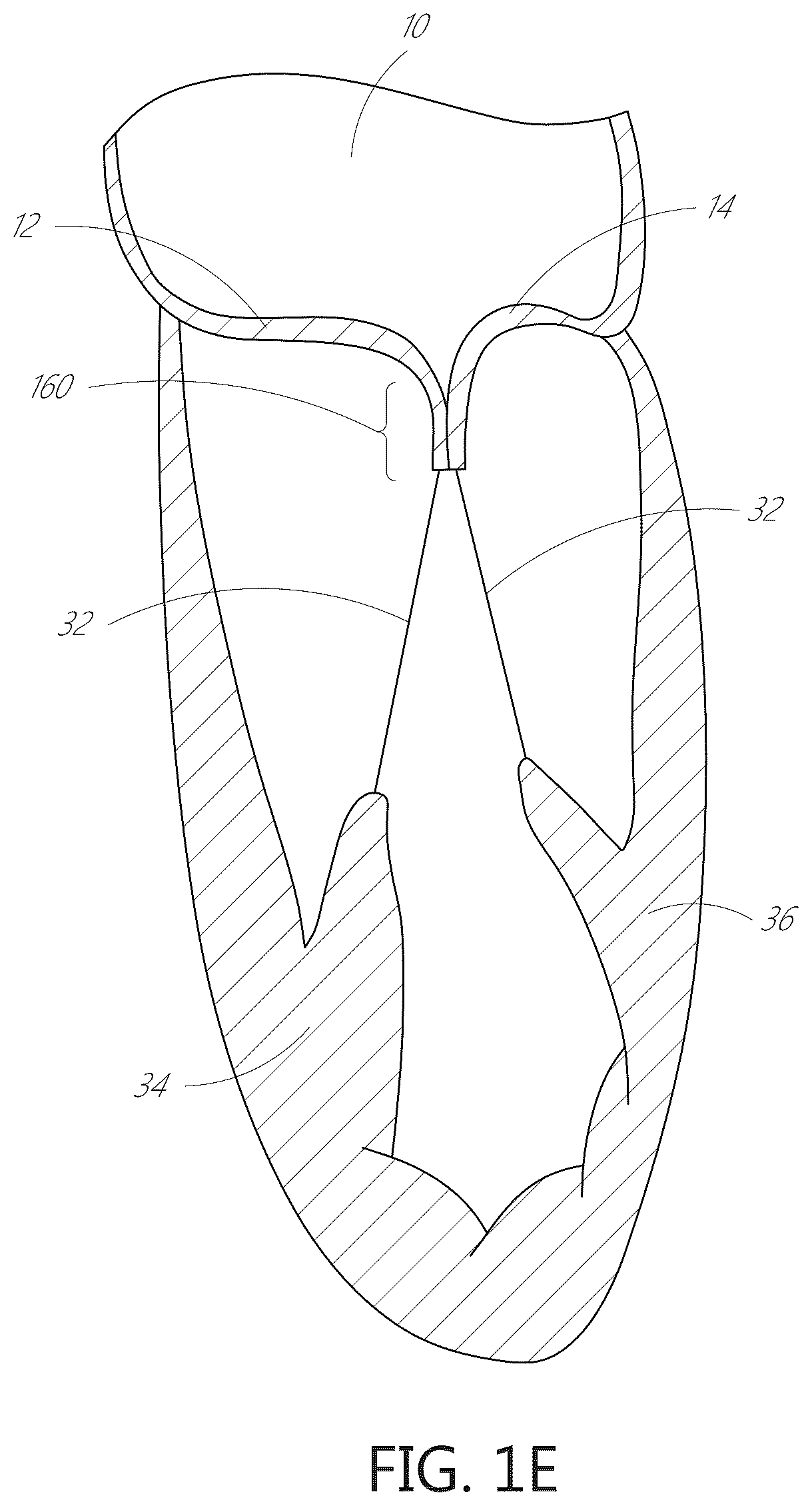 Patent US12599482 Figure 3 – Device, system, and method for transcatheter treatment of valvular regurgitation with secondary anchors