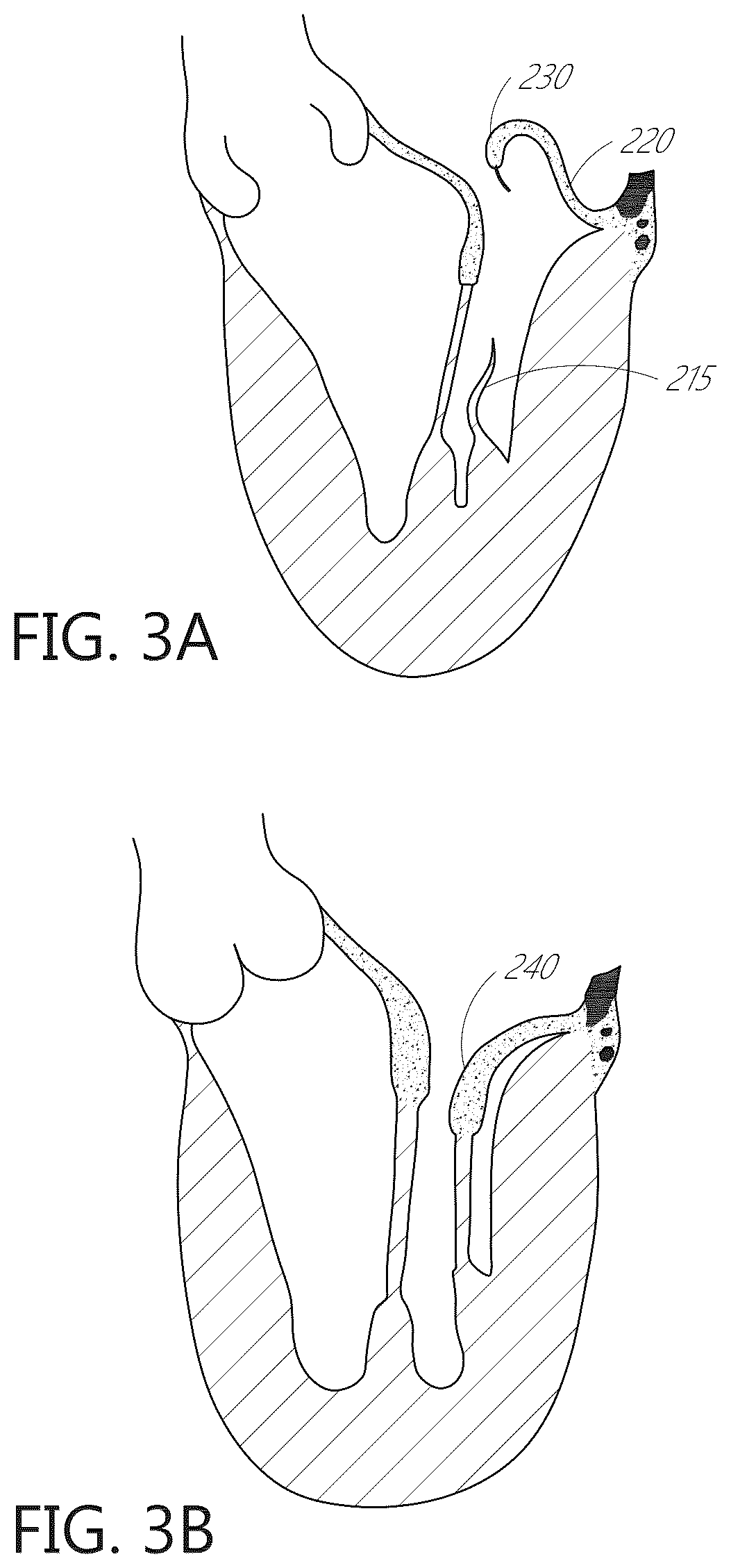 Patent US12599482 Figure 6 – Device, system, and method for transcatheter treatment of valvular regurgitation with secondary anchors