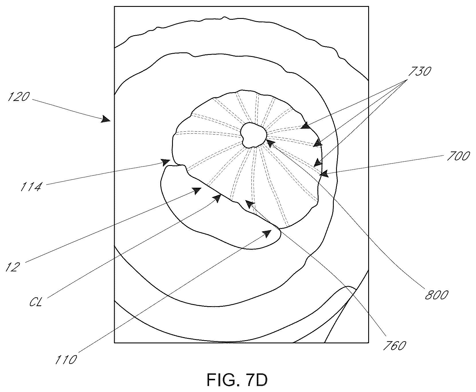 Patent US12599482 Figure 18 – Device, system, and method for transcatheter treatment of valvular regurgitation with secondary anchors