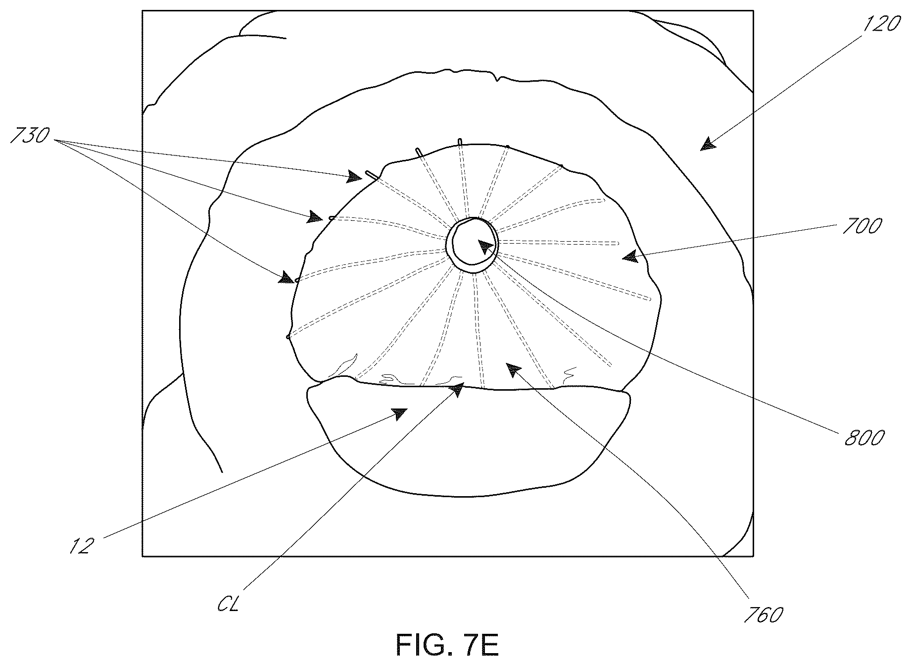 Patent US12599482 Figure 19 – Device, system, and method for transcatheter treatment of valvular regurgitation with secondary anchors