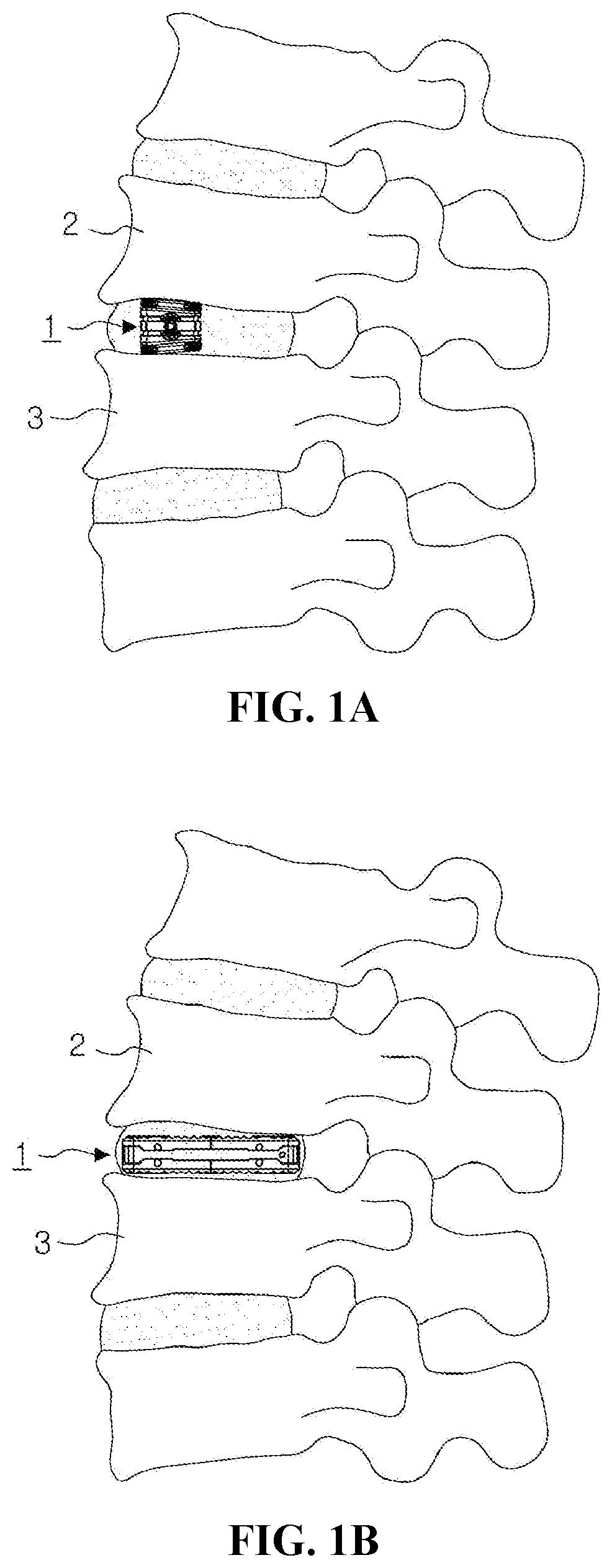 Patent US12599488 Figure 1 – Bi-planar expandable cage for spine