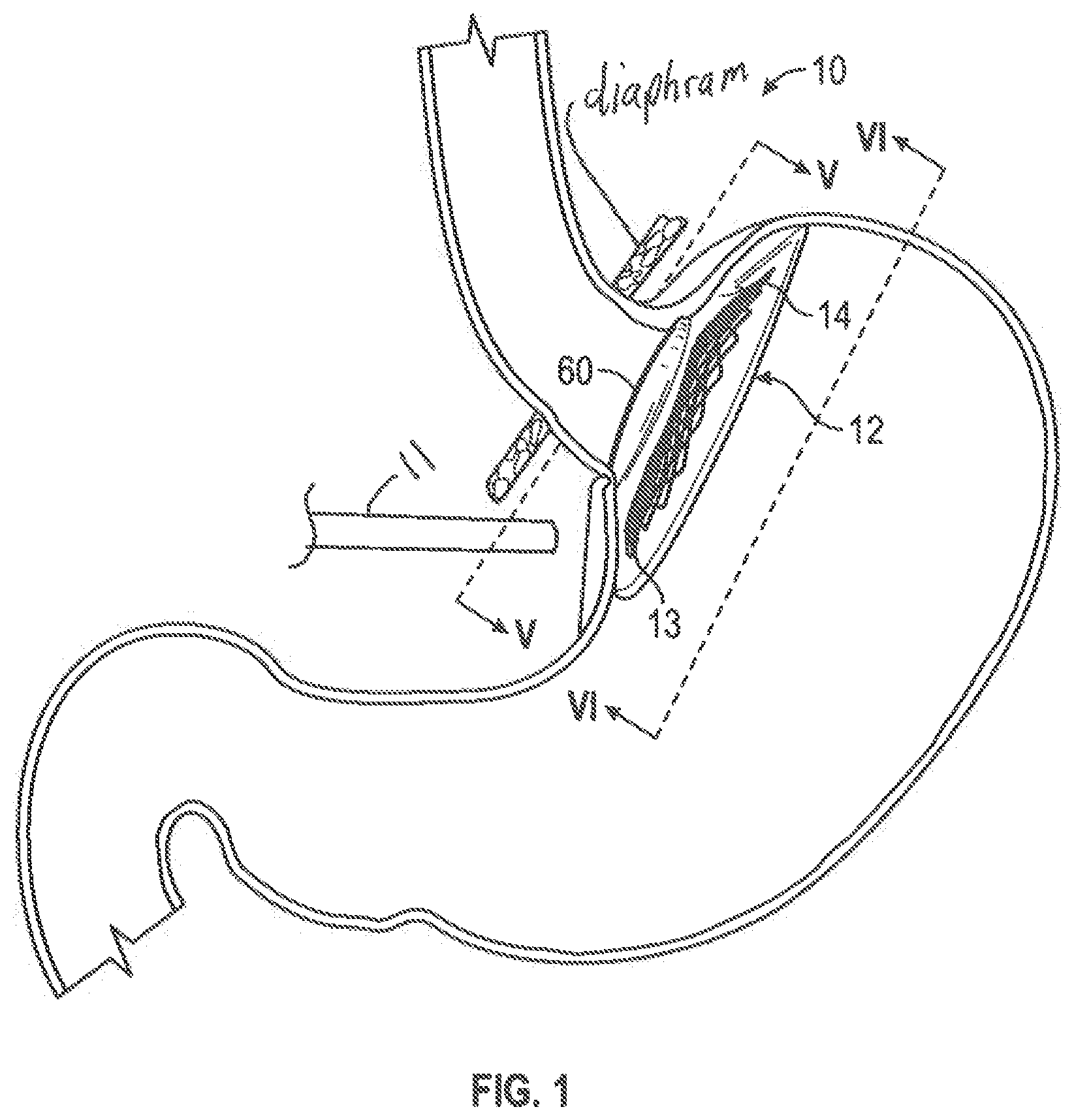 Patent US12599493 — Method of deploying an intraluminal device and intraluminal system — Figure 1