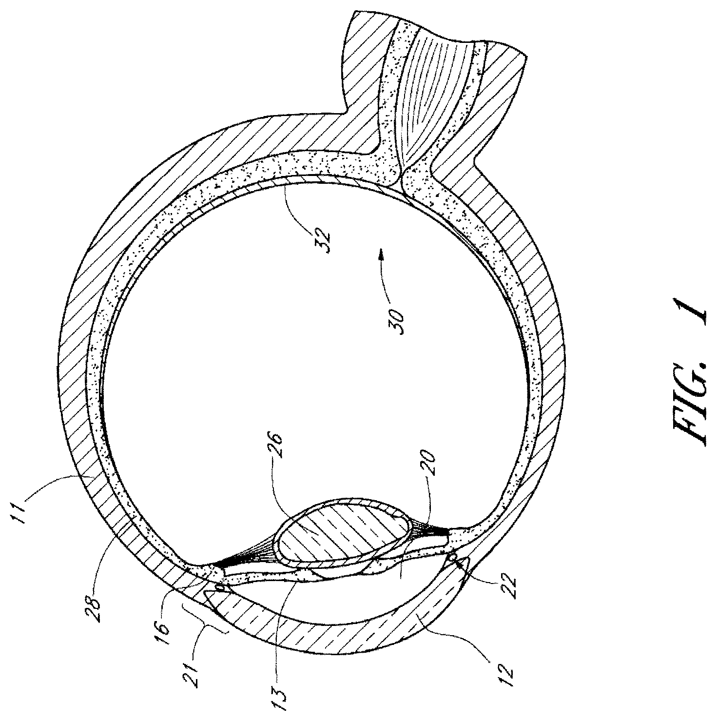 Patent US12599497 — Implants with controlled drug delivery features and methods of using same — Figure 1