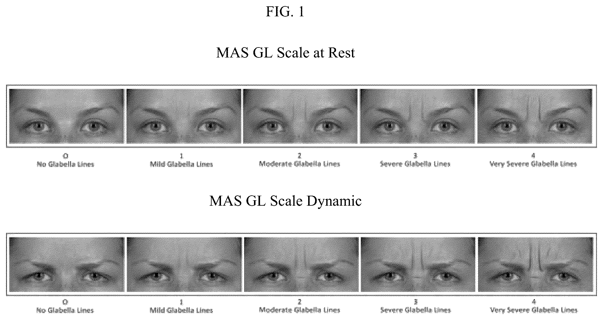 Patent US12599549 Figure 1 – Treatment of moderate to very severe glabellar lines and lateral canthal lines