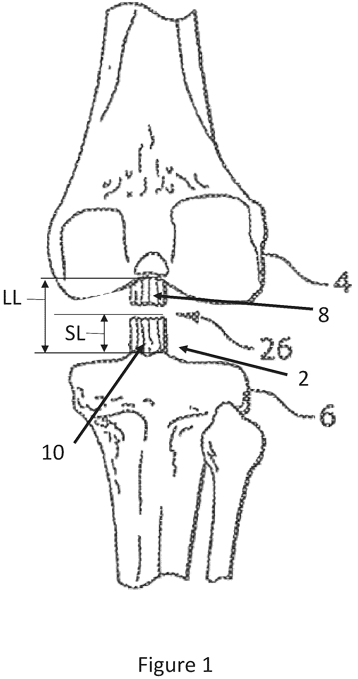 Patent US12599700 — System and methods for connective tissue repair using scaffolds — Figure 1