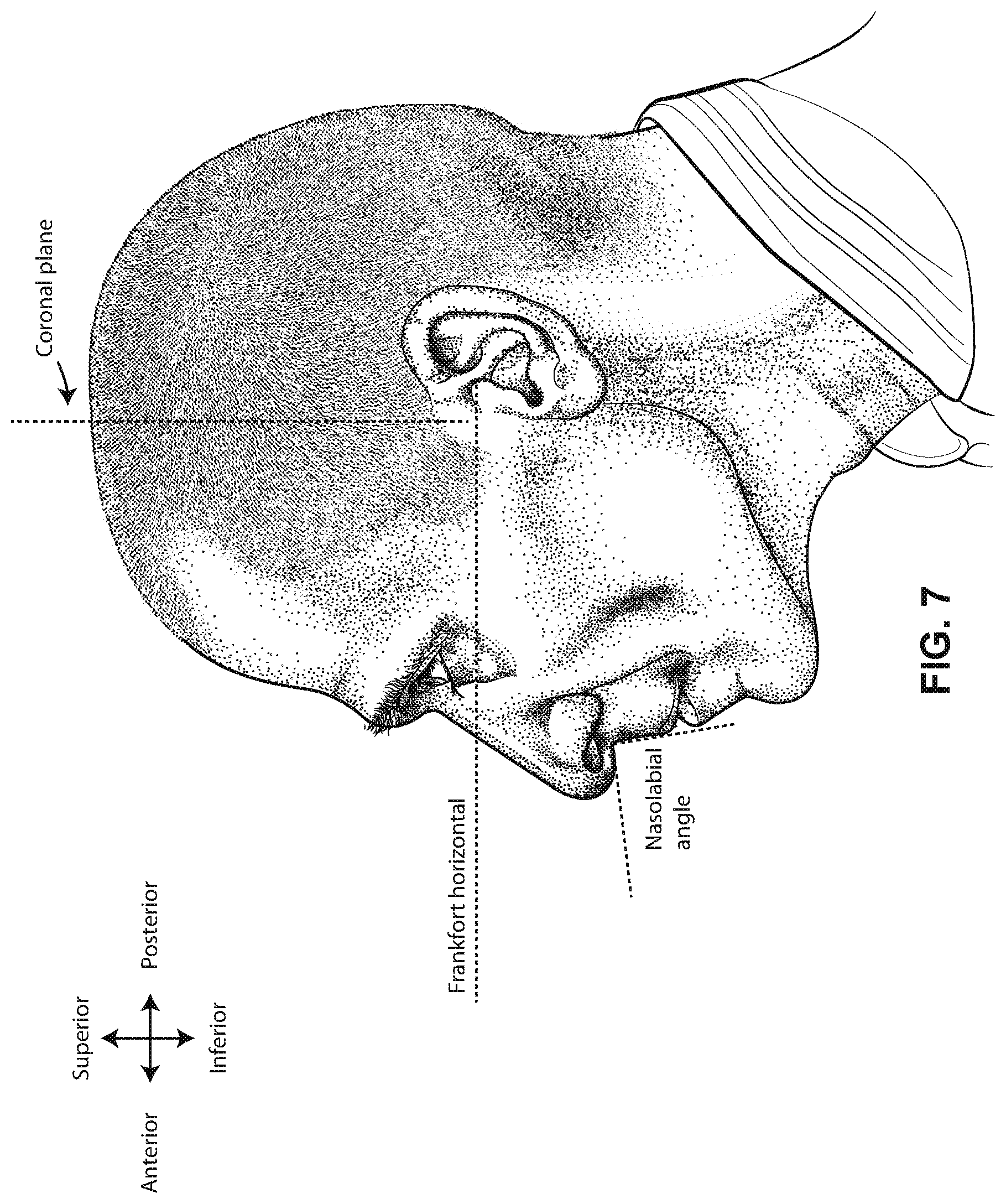 Patent US12599739 Figure 7 – Patient interface with foam cushion