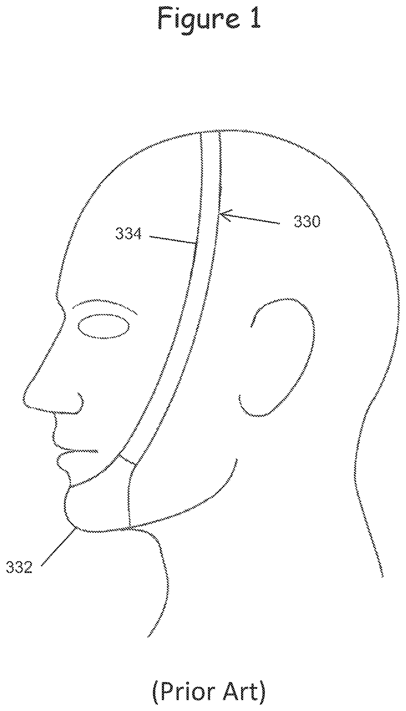 Patent US12599740 — Oral appliance for use with CPAP headgear — Figure 1