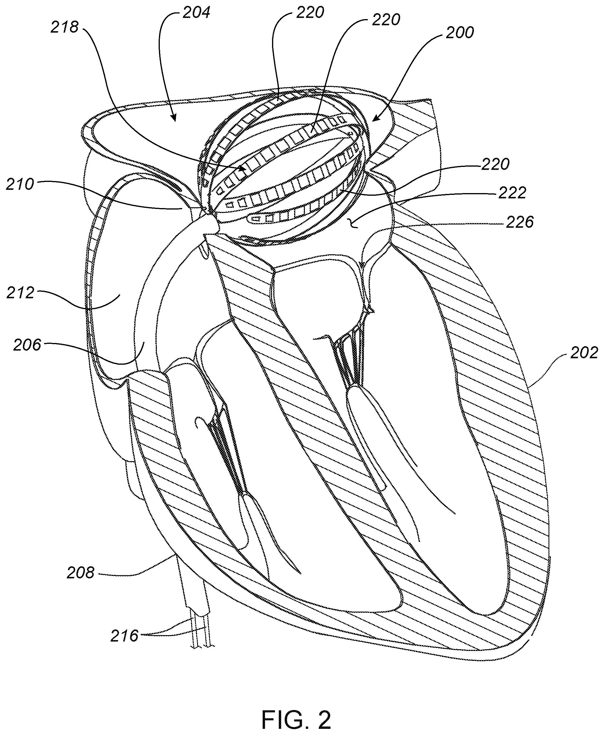 Patent US12599747 Figure 2 – Medical device systems and methods including safety release, lumen fluid-providing mechanisms, or both