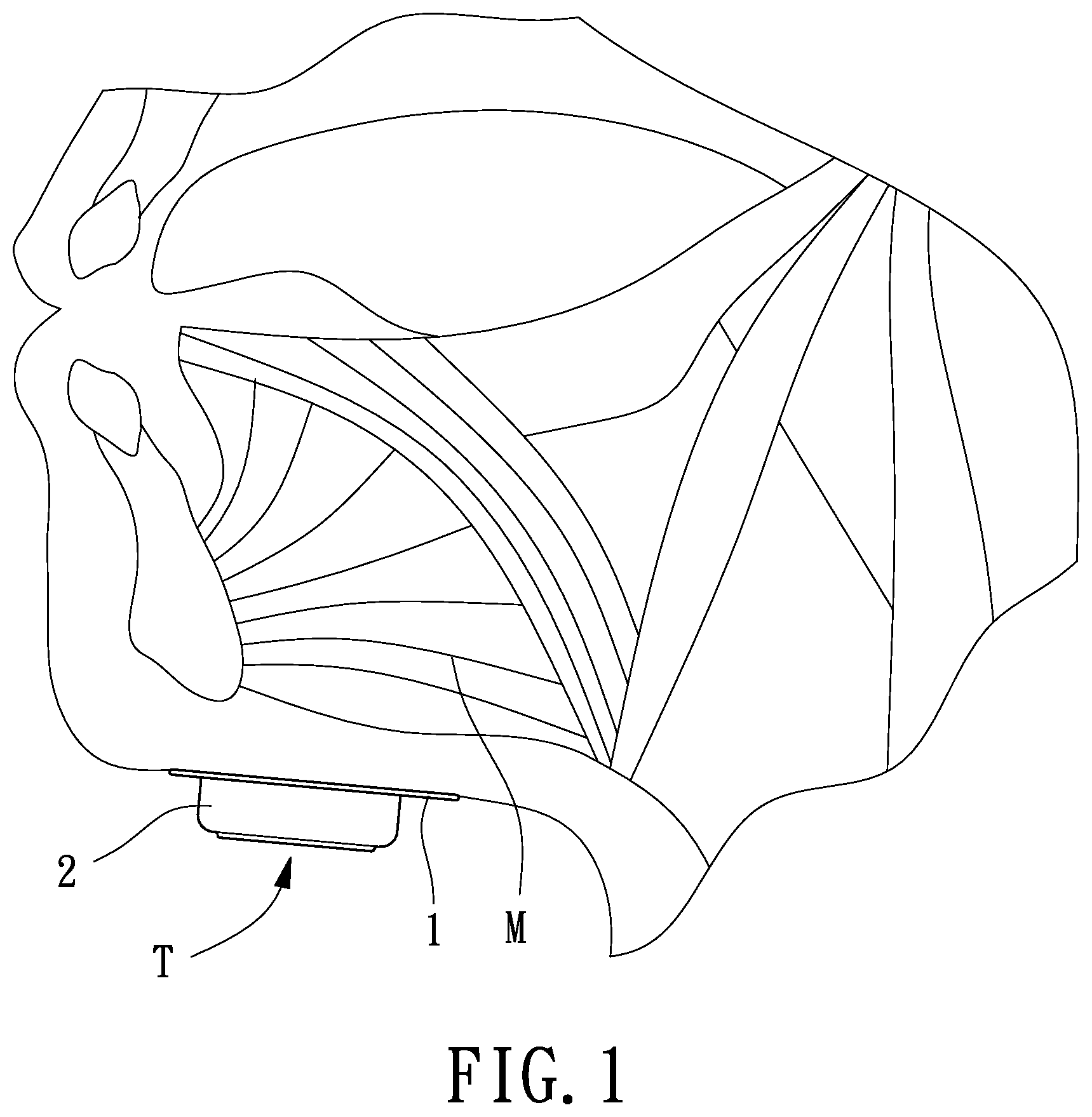 Patent US12599759 — Non-implantable training method for training genioglossus muscle strength — Figure 1