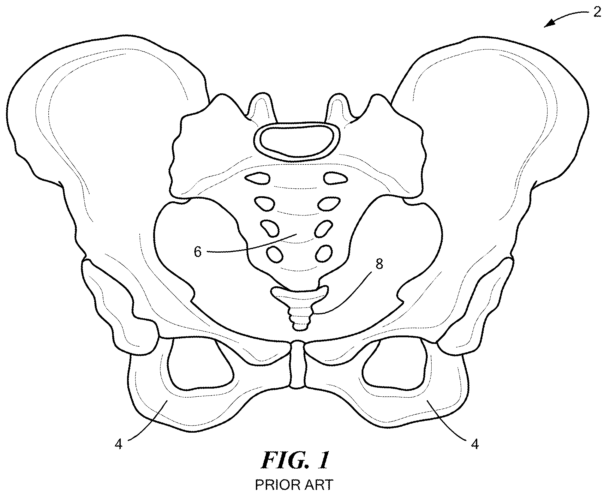Patent US12611036 — Stackable lift for ischial tuberosity re-alignment of sacral/lumbar complex and method of use — Figure 1
