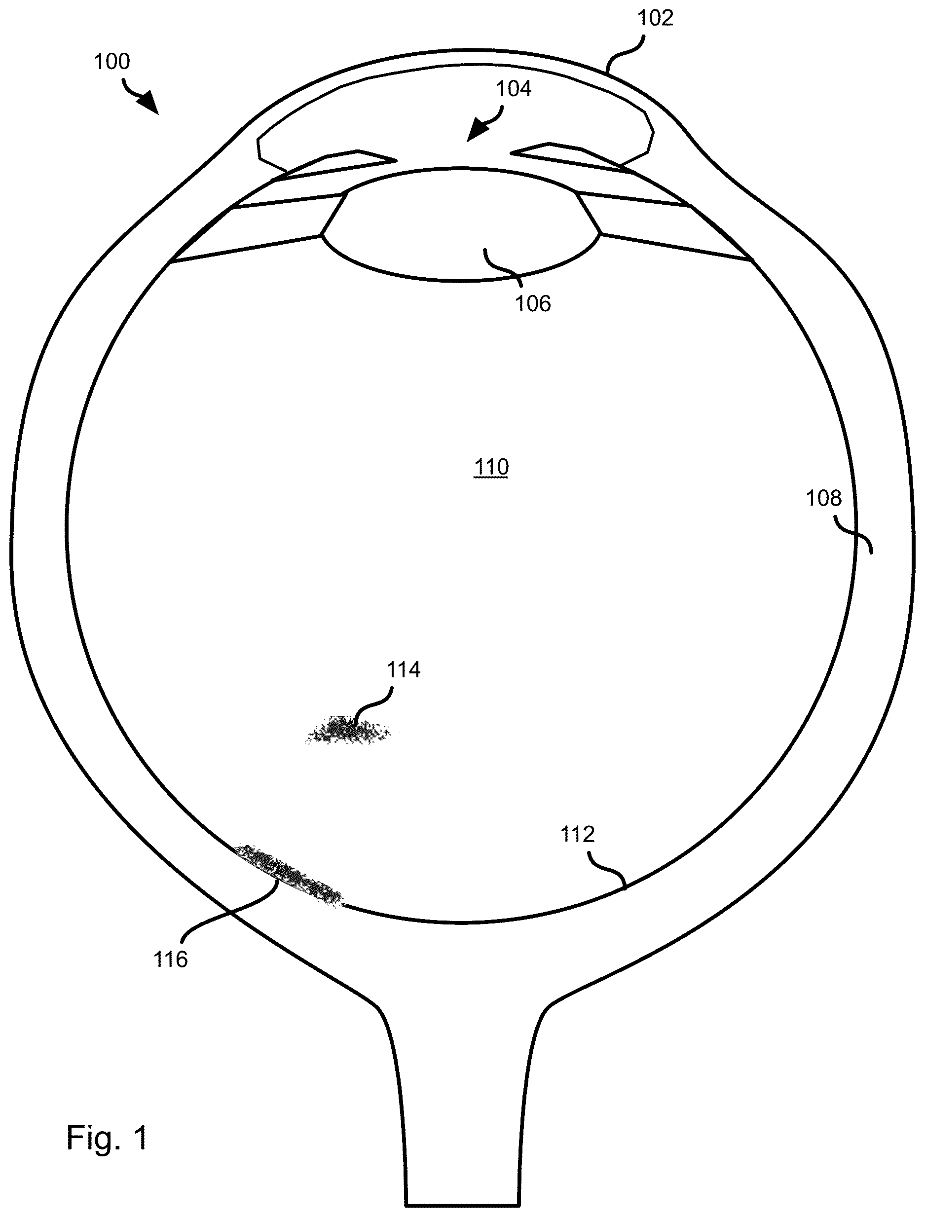 Patent US12611099 — Psychophysical evaluation of the effect of vitreous floaters — Figure 1