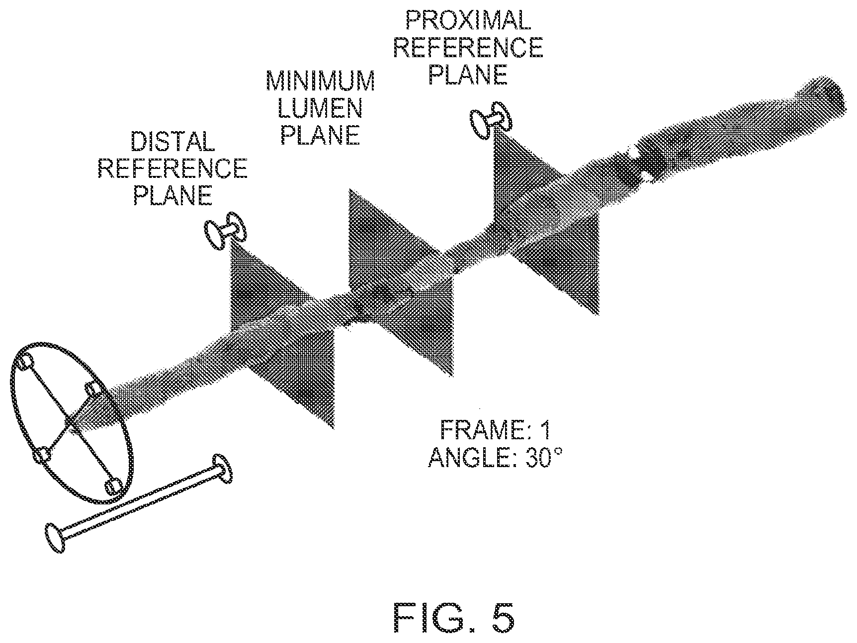 Patent US12611109 Figure 5 – Lumen morphology and vascular resistance measurements data collection systems apparatus and methods