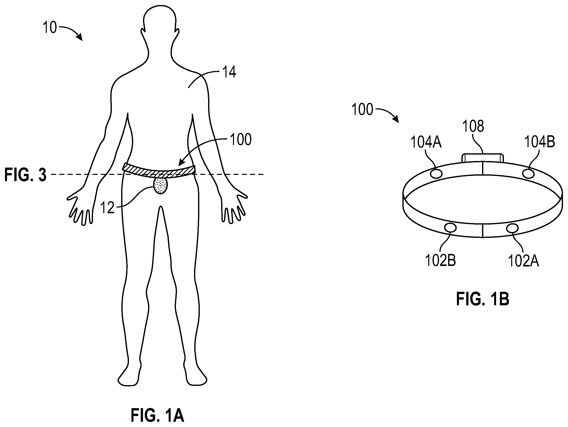 Patent US12611130 Figure 1 – Self-learning and non-invasive bladder monitoring systems and methods