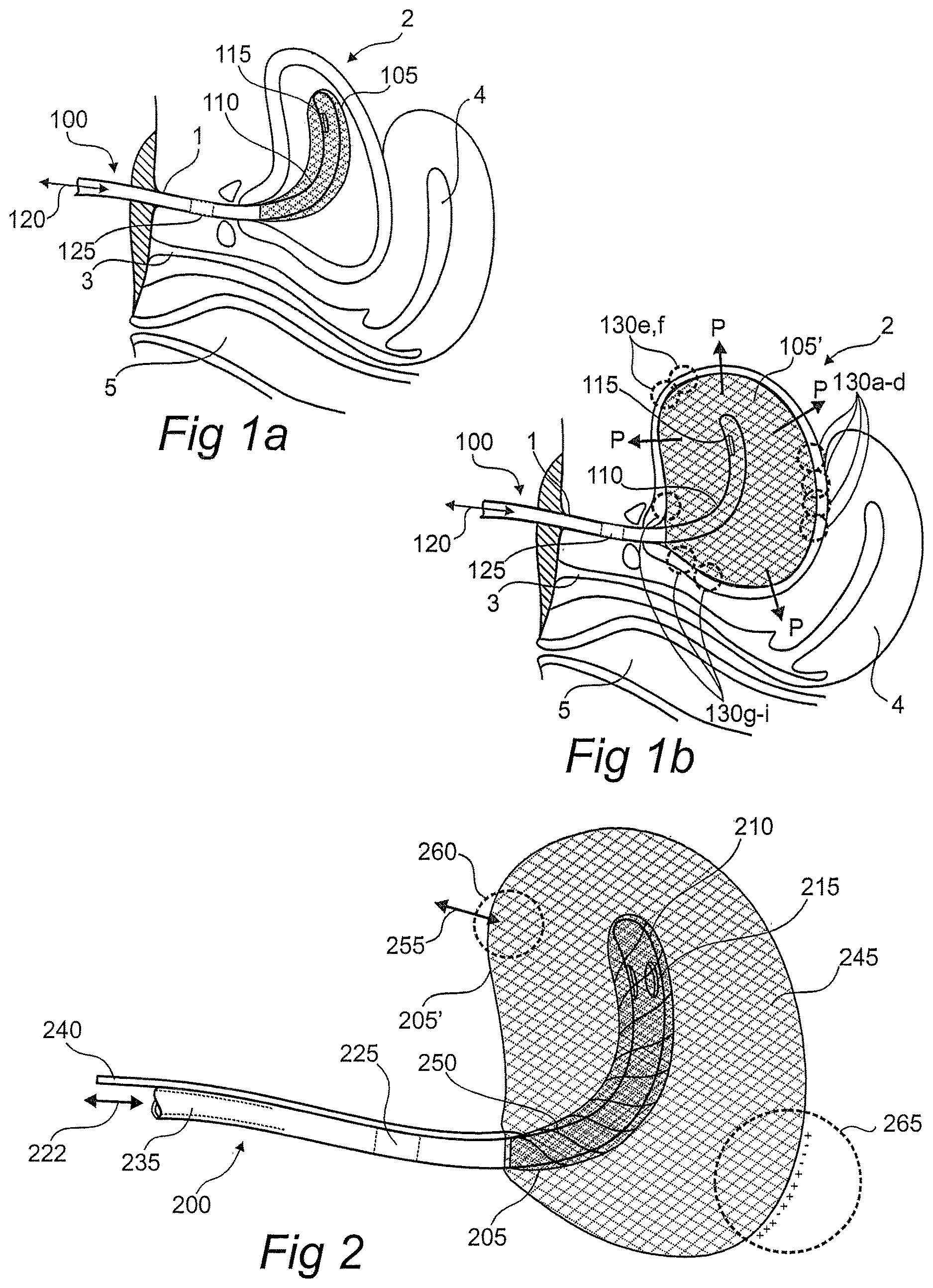 Patent US12611134 — Devices, systems, and methods for diagnosis and treatment of overactive bladder — Figure 1