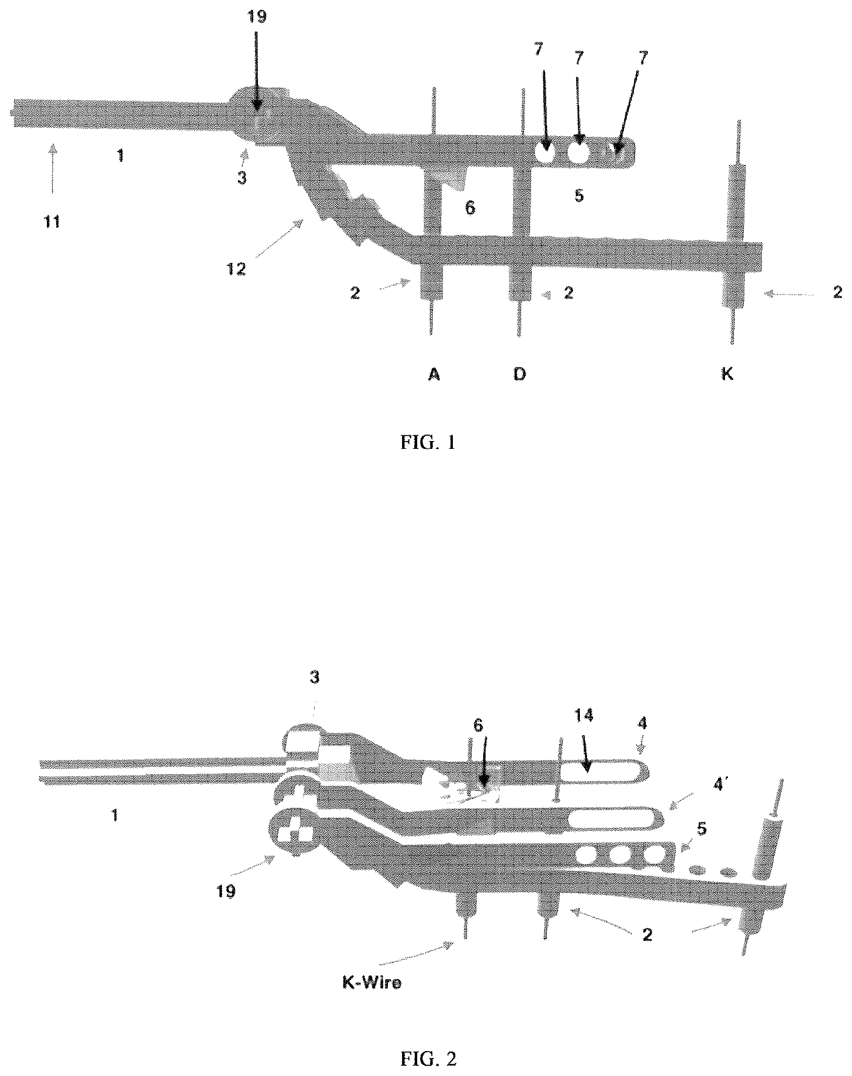 Patent US12611218 — Device for tension band wiring fixation of fractures, particularly of olecranon, and olecranon osteotomy and method therefor — Figure 1