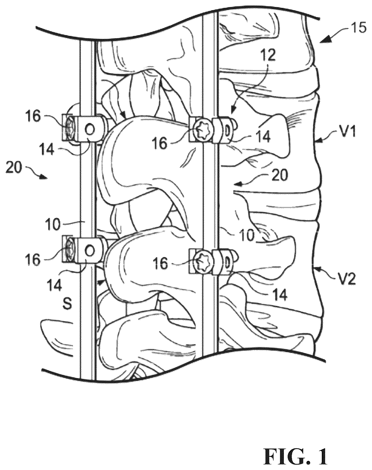 Patent US12611231 Figure 1 – Spinal rod and systems thereof