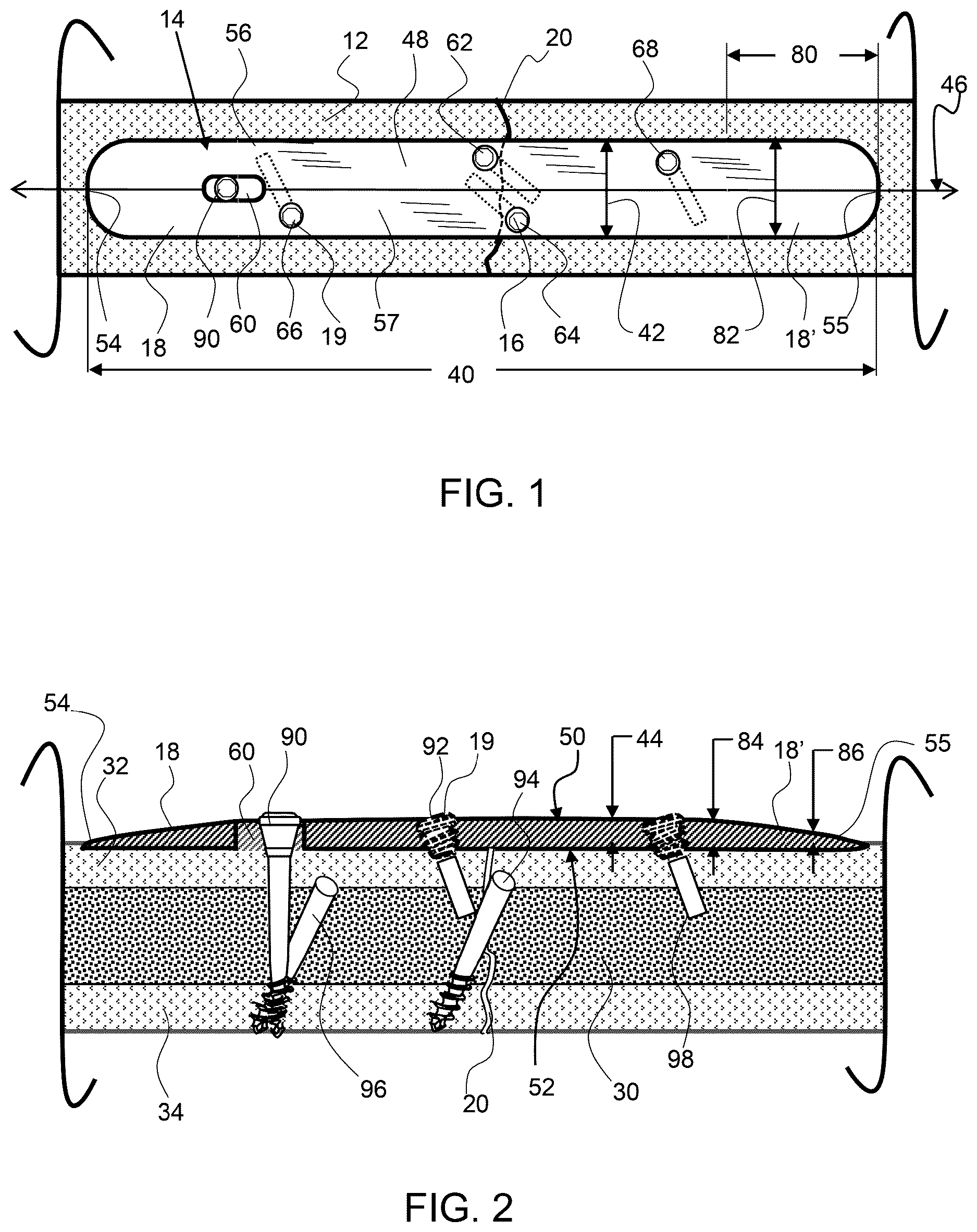 Patent US12611237 — Load sharing bone plate — Figure 1