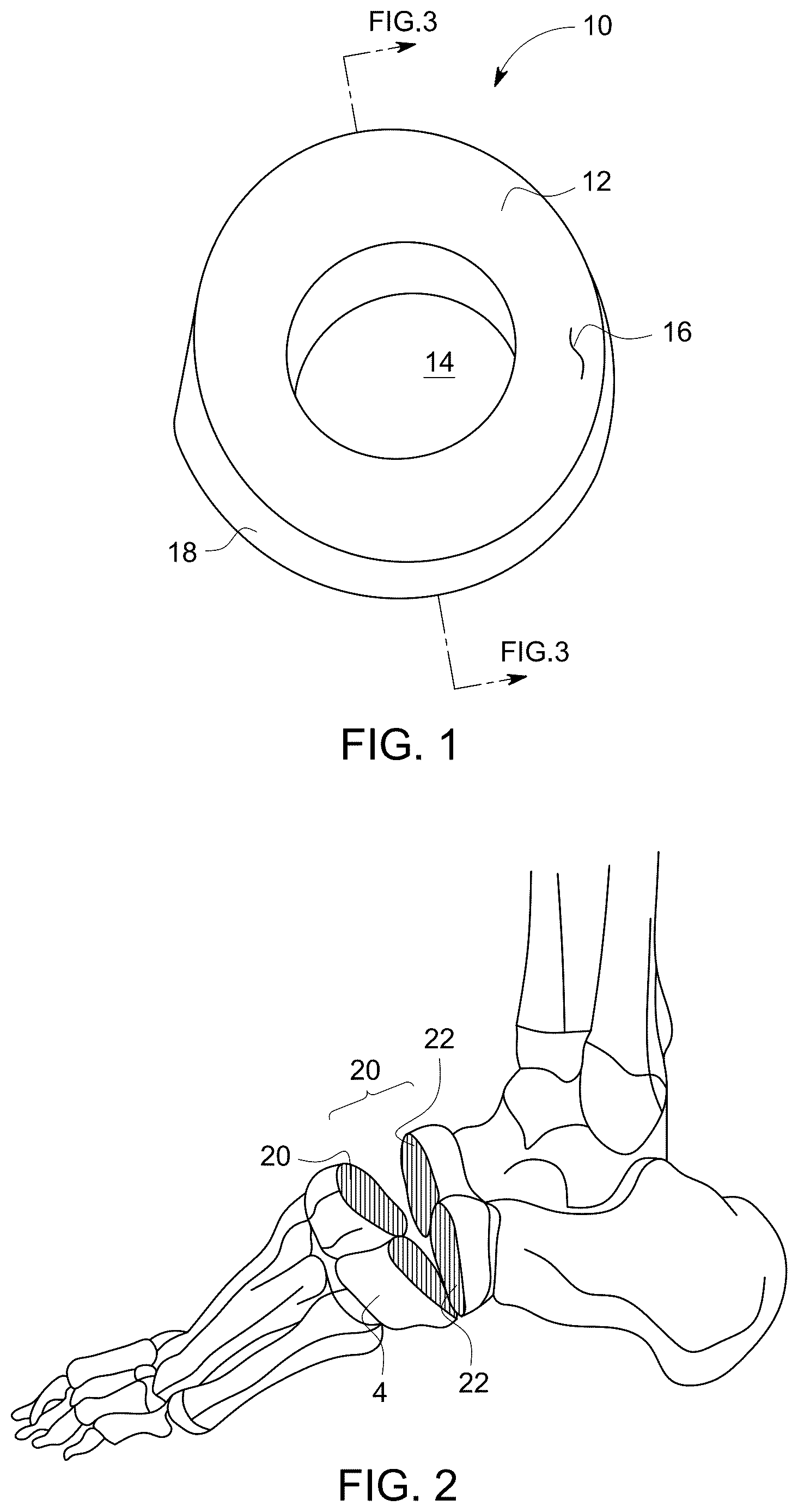 Patent US12611238 — Wedge osteotomy devices, systems, and methods for treating mid-foot disorders — Figure 1