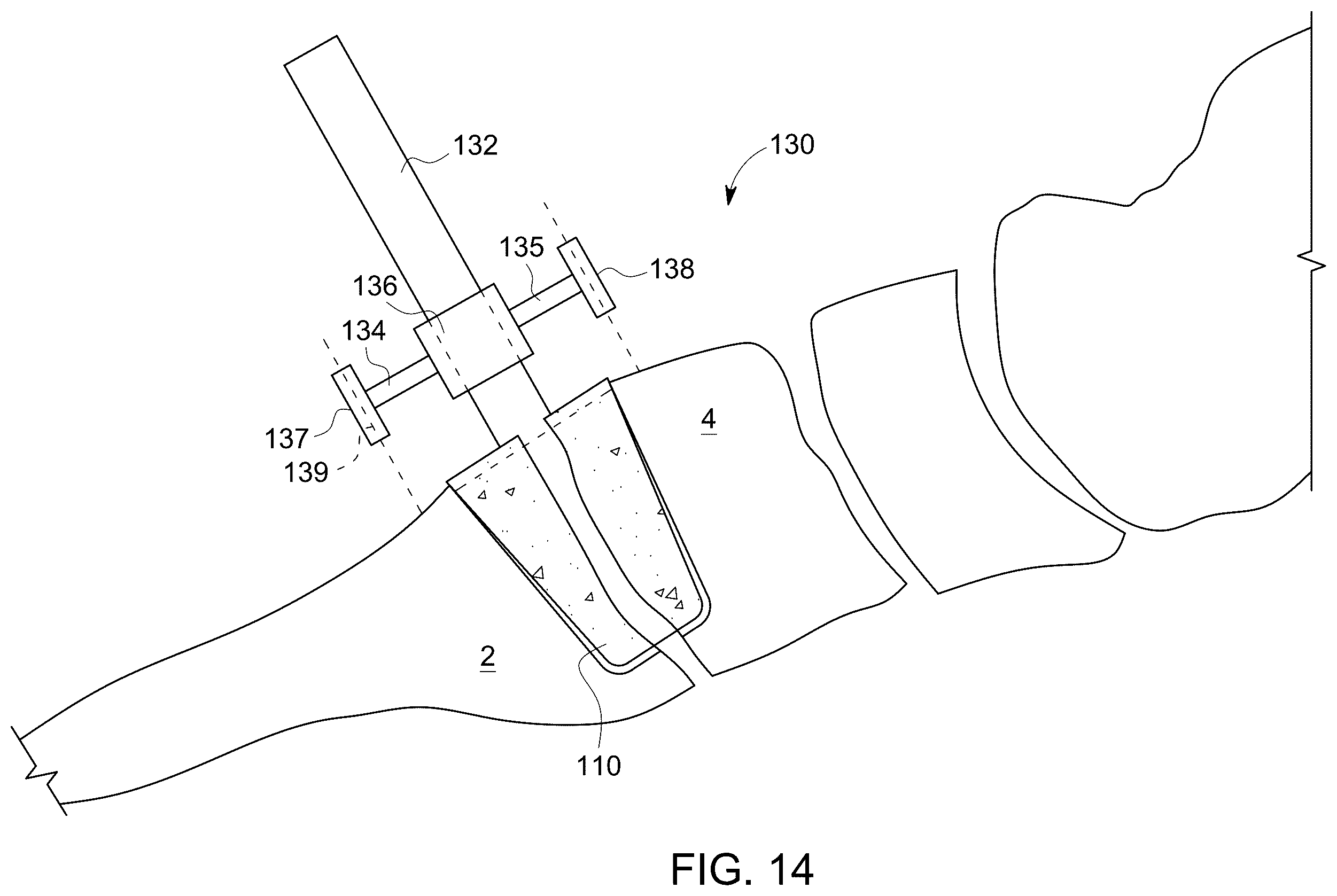Patent US12611238 Figure 8 – Wedge osteotomy devices, systems, and methods for treating mid-foot disorders