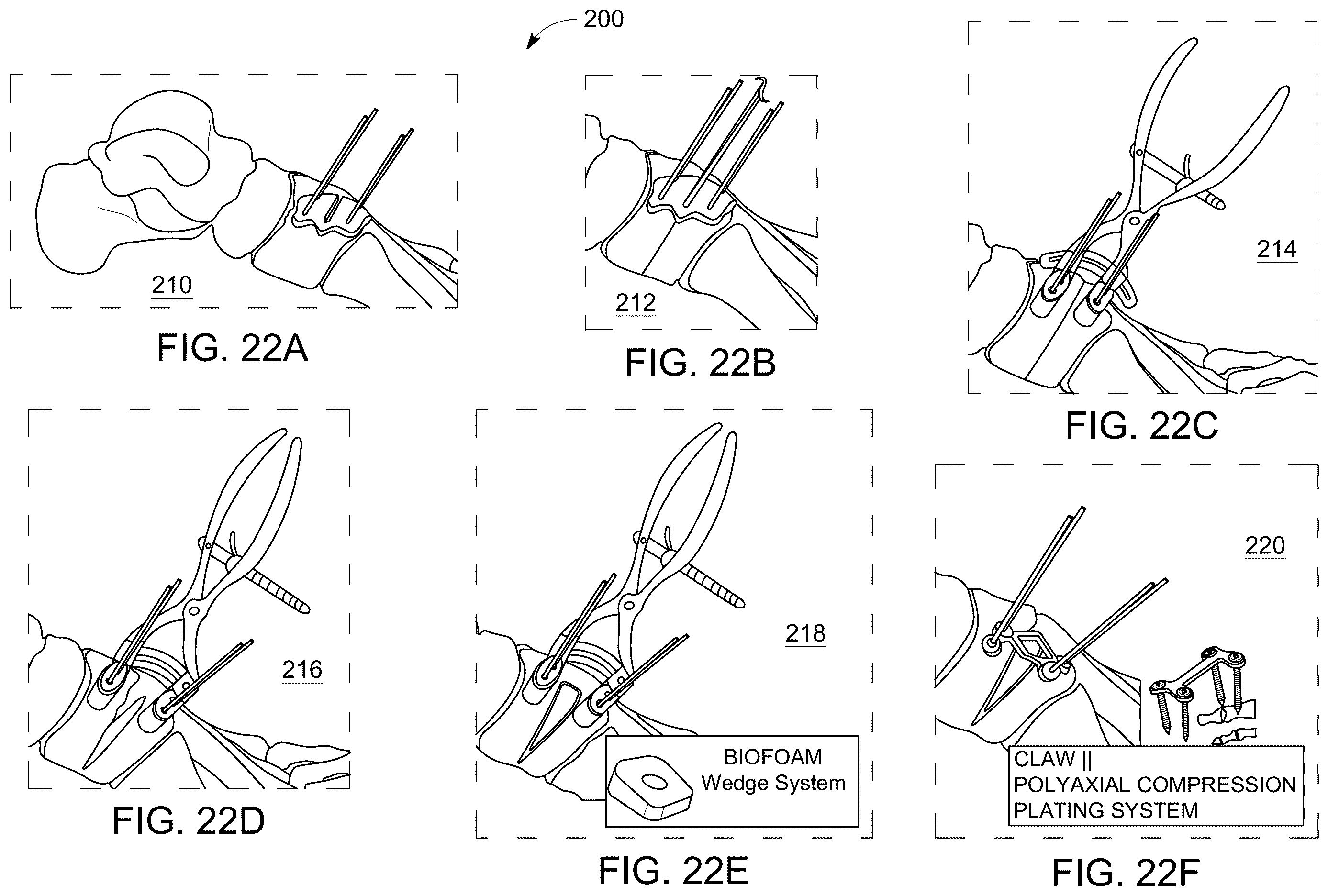 Patent US12611238 Figure 13 – Wedge osteotomy devices, systems, and methods for treating mid-foot disorders