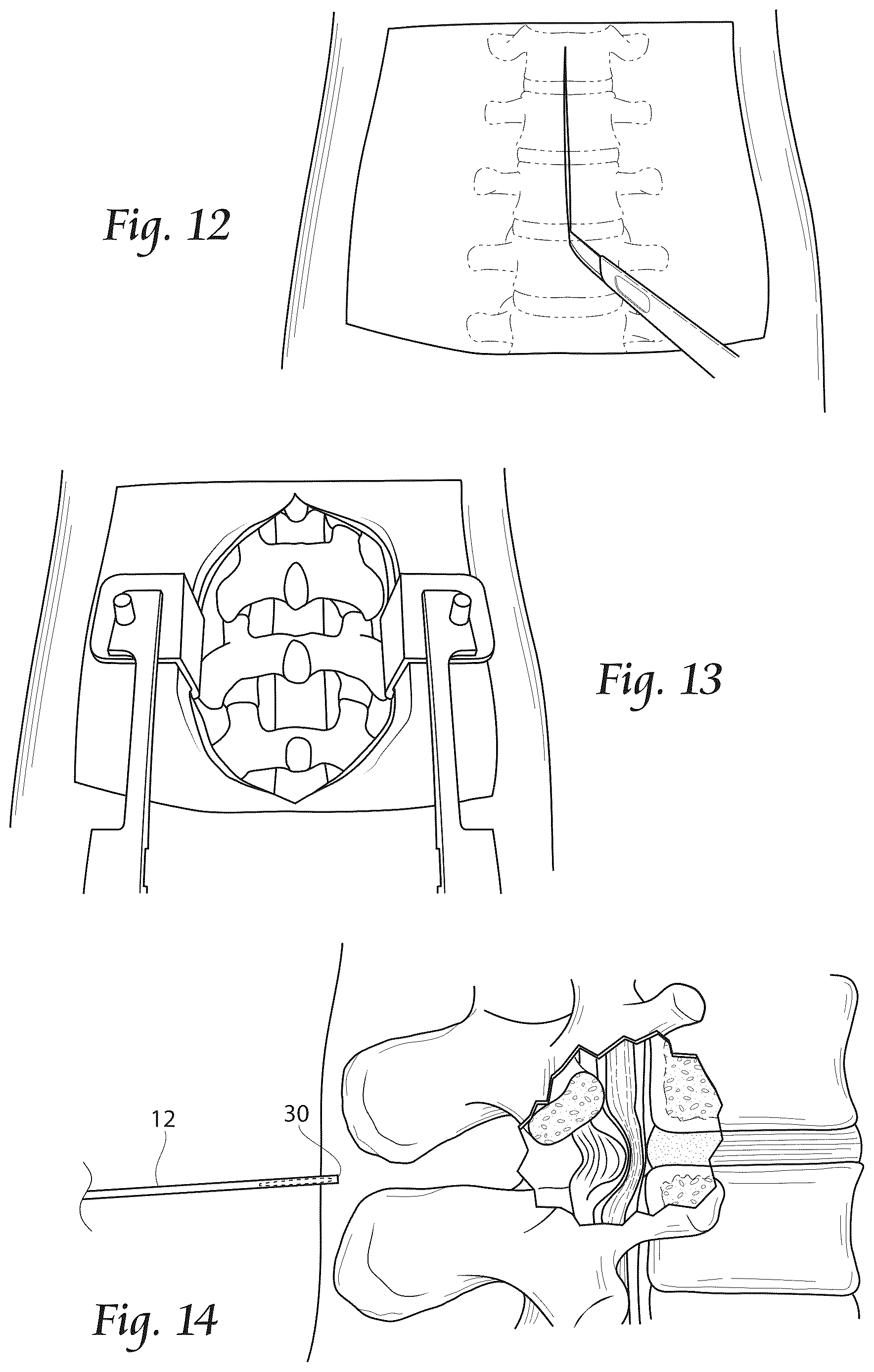 Patent US12611241 Figure 7 – Methods, systems, and devices for the treatment of stenosis