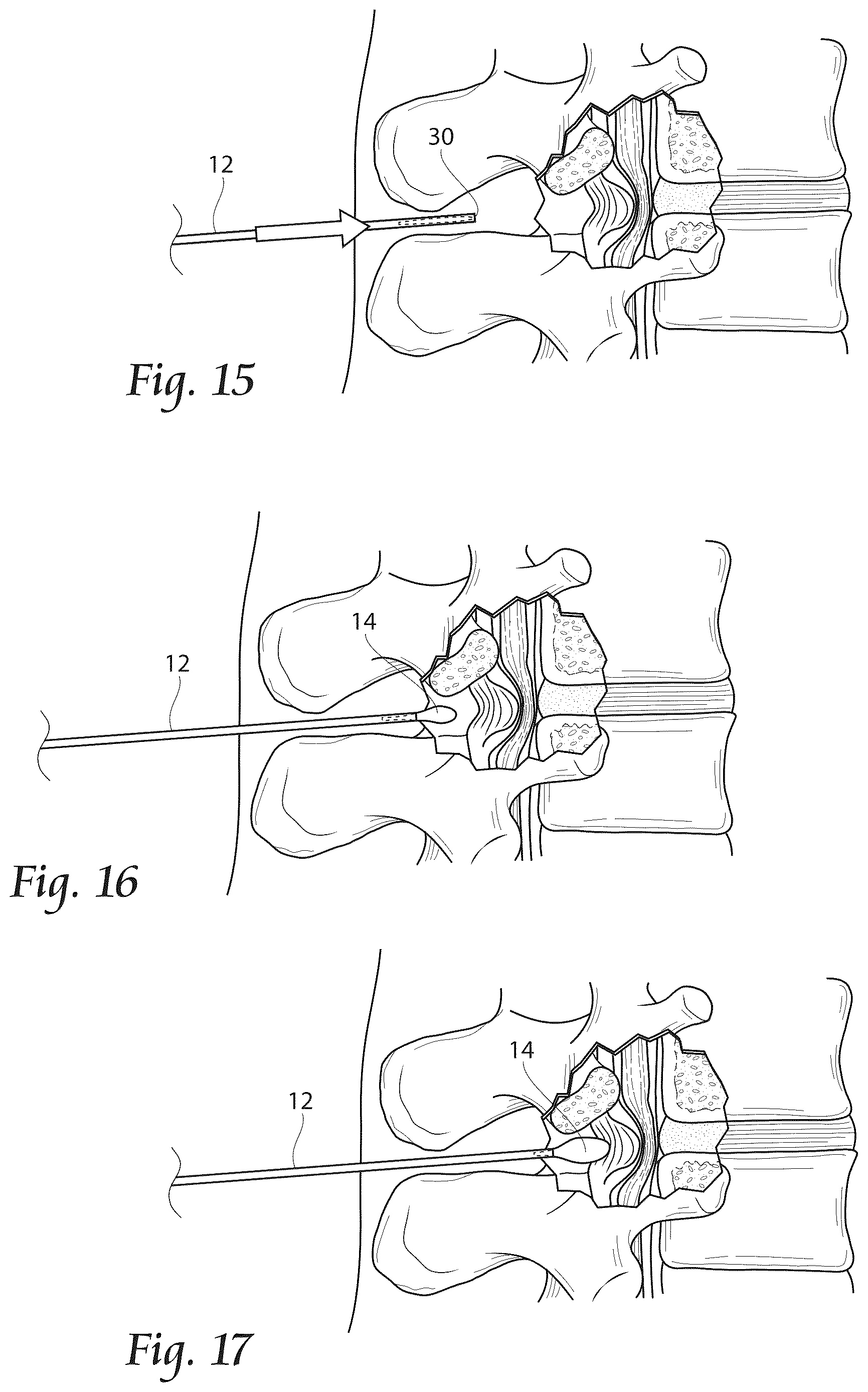 Patent US12611241 Figure 8 – Methods, systems, and devices for the treatment of stenosis