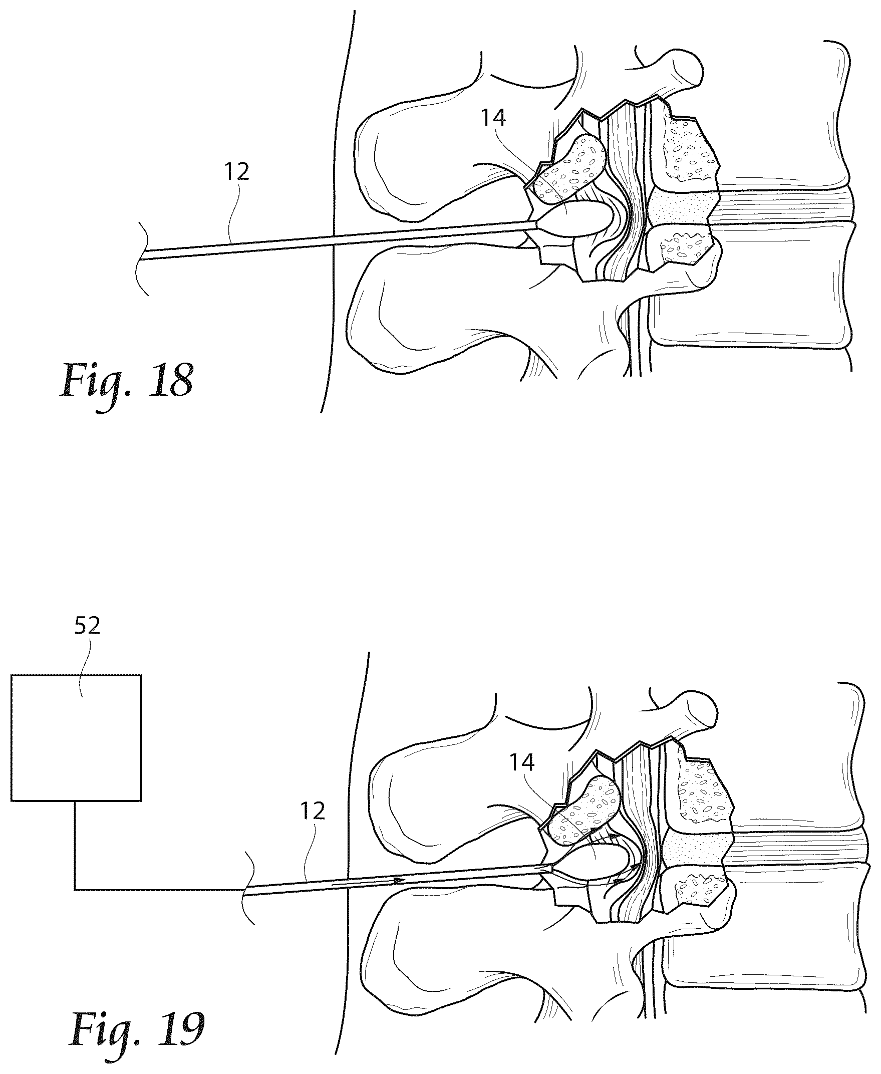 Patent US12611241 Figure 9 – Methods, systems, and devices for the treatment of stenosis