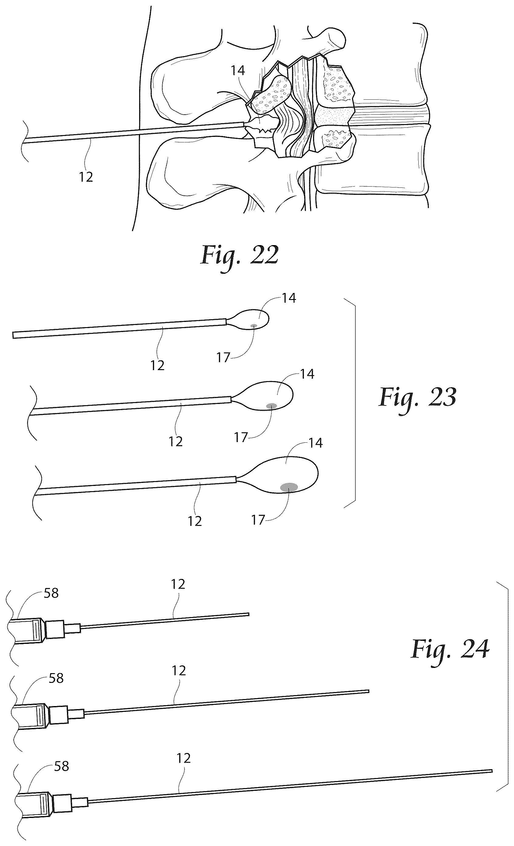 Patent US12611241 Figure 11 – Methods, systems, and devices for the treatment of stenosis