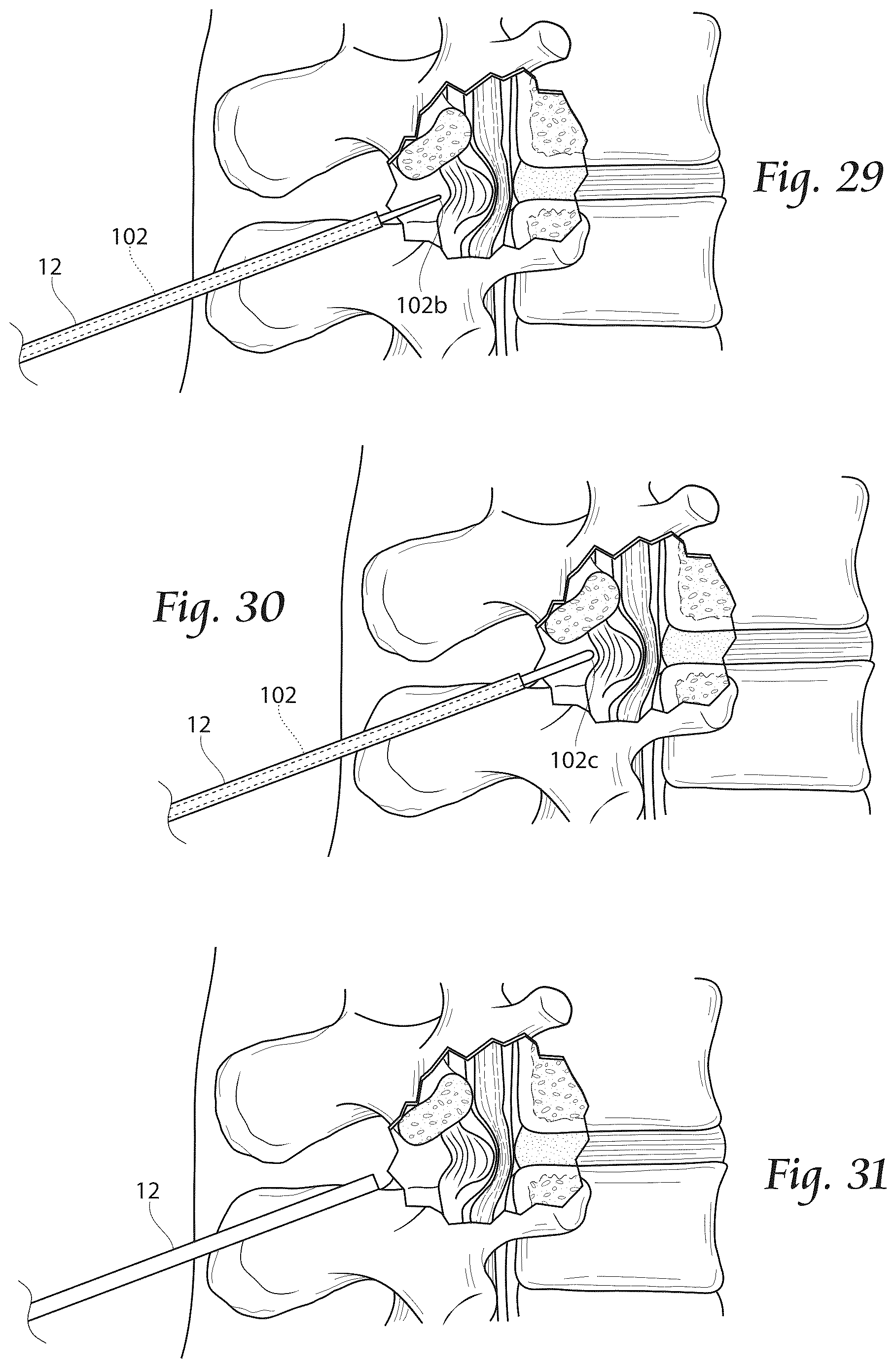 Patent US12611241 Figure 14 – Methods, systems, and devices for the treatment of stenosis