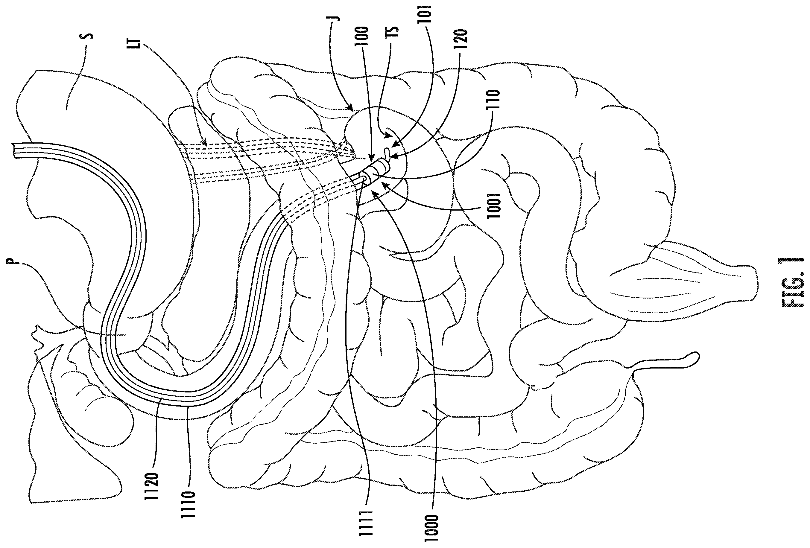 Patent US12611285 — Wireless devices, systems, and methods for endoscopic positioning — Figure 1