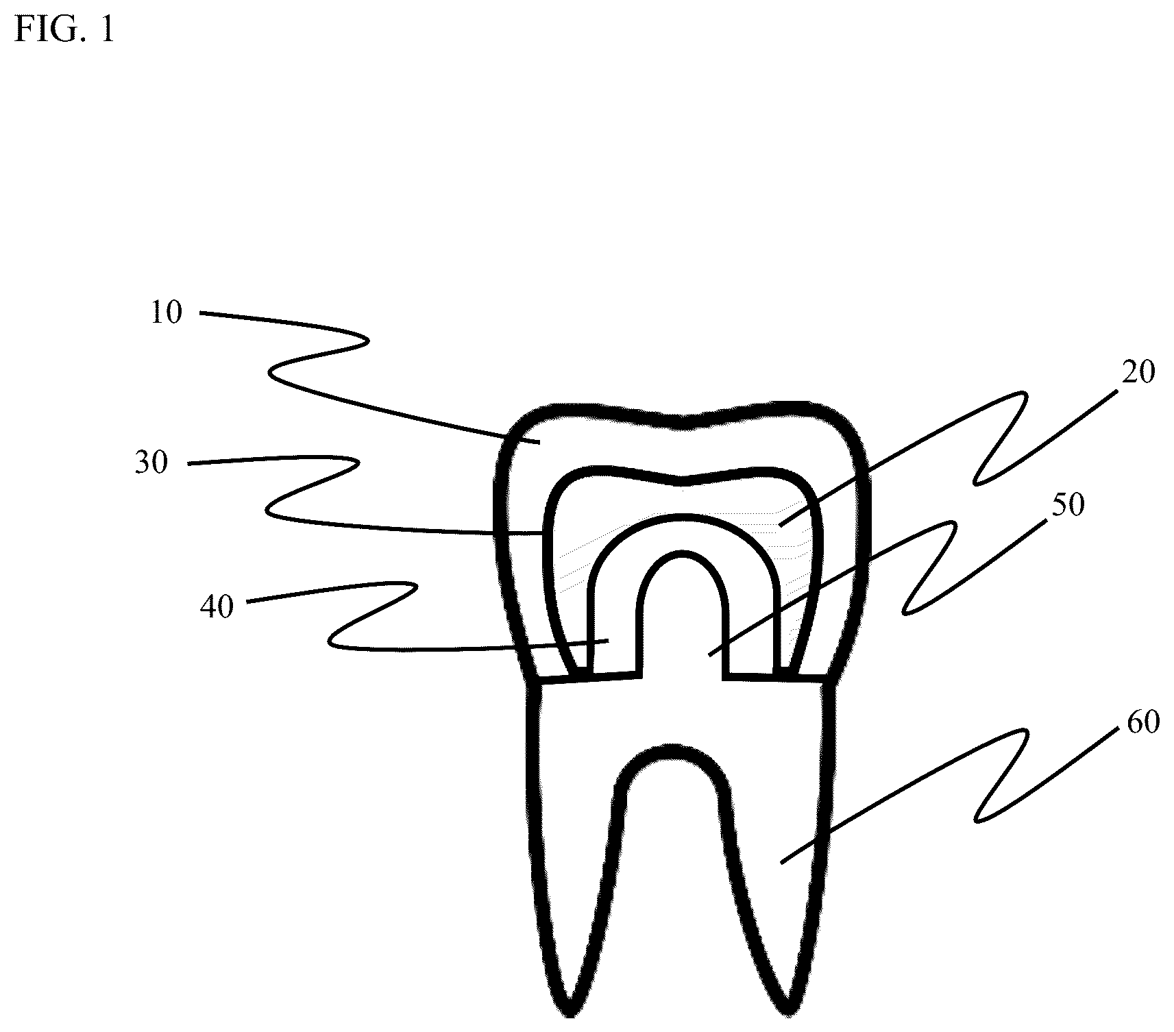 Patent US12611286 Figure 1 – Method and apparatus for dental crown restorations using prefabricated sleeve-crown pairs