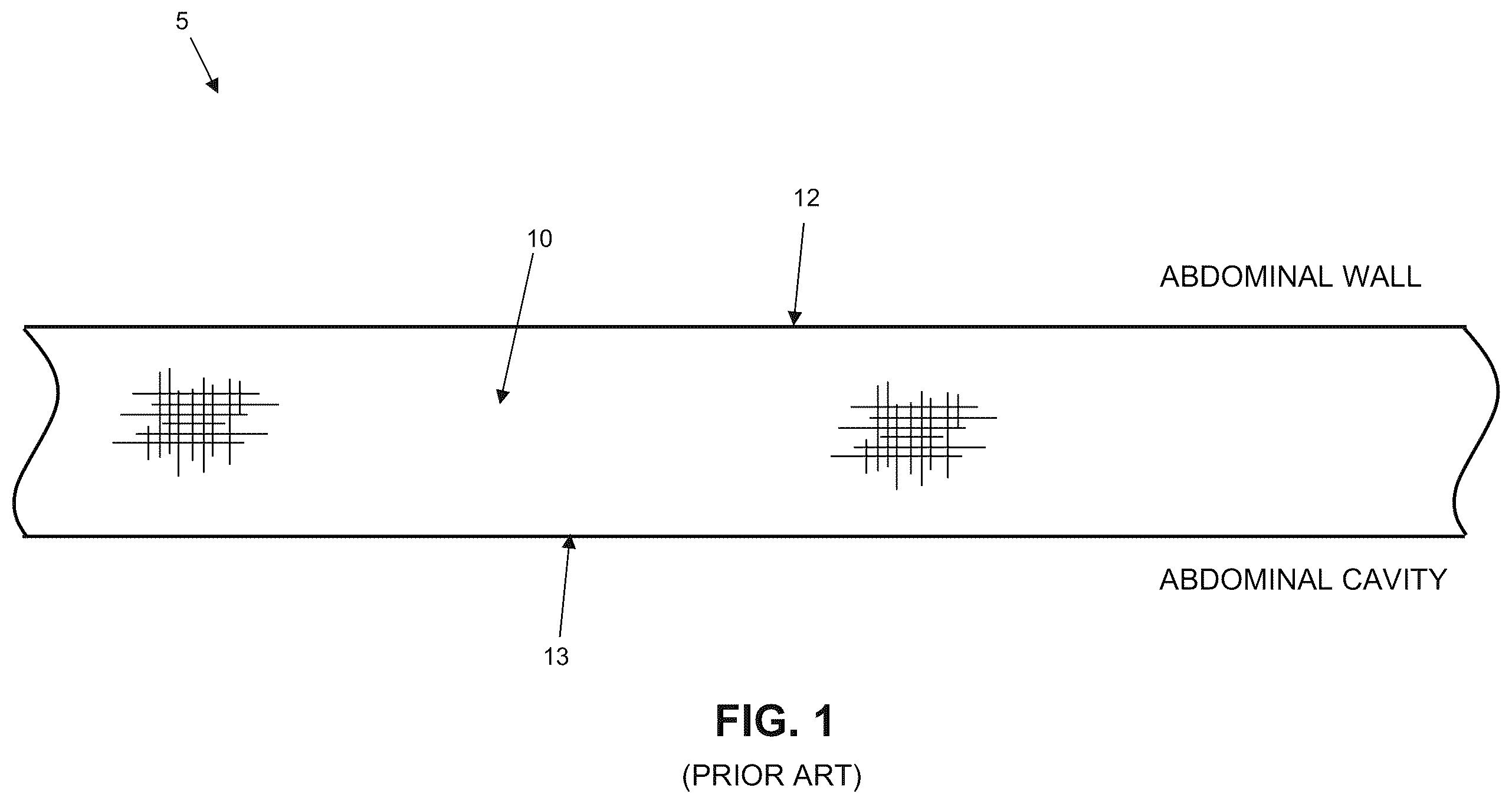 Patent US12611293 Figure 1 – Surgical mesh having ingrowth-preventing coating on one side thereof, and method for making the same