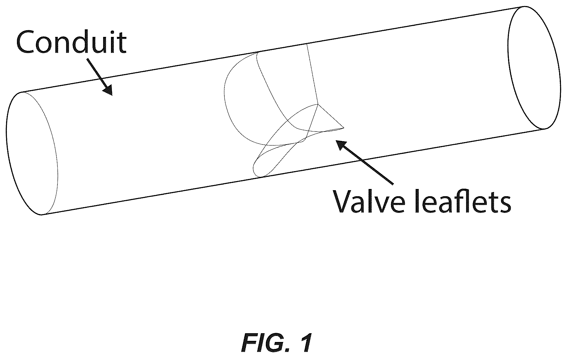 Patent US12611299 Figure 1 – Transcatheter dilatable biostable polymeric stented valved tube prosthesis