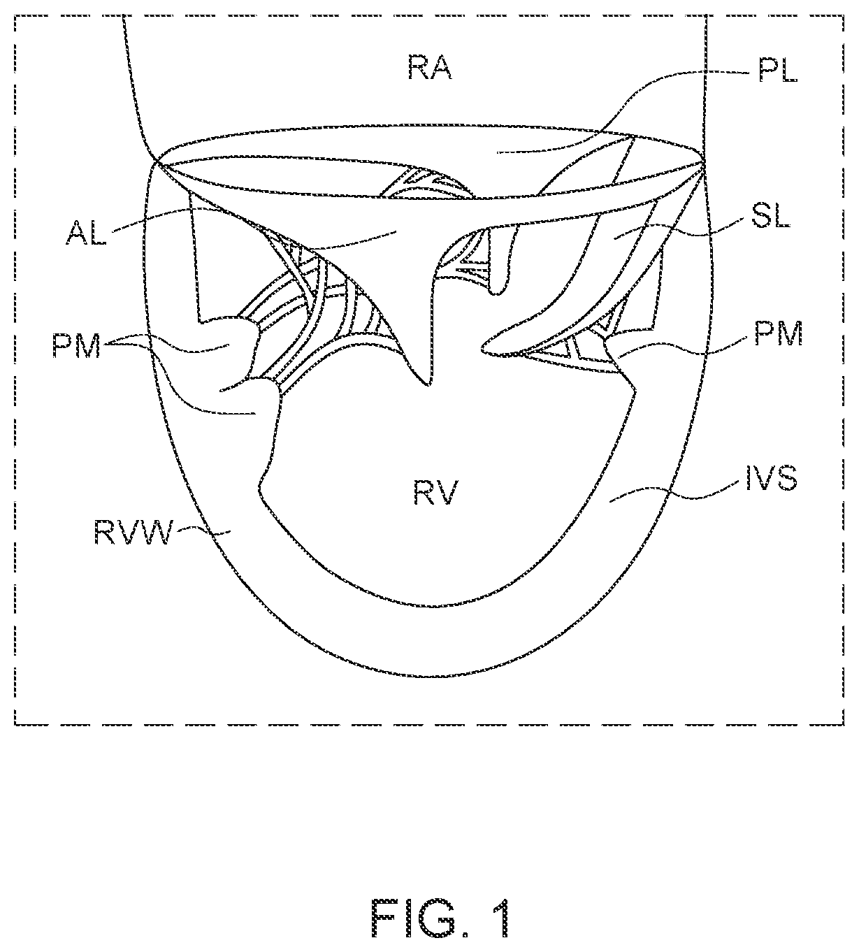 Patent US12611300 Figure 1 – Transcatheter prosthetic atrioventricular valve