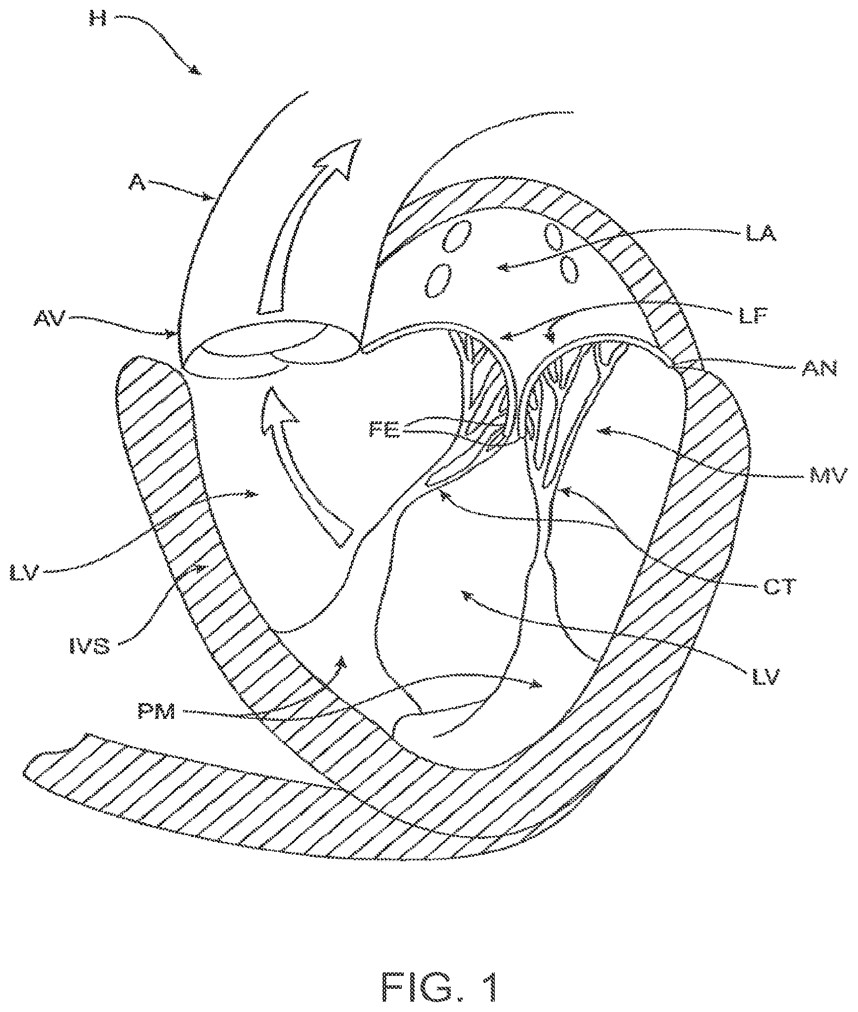 Patent US12611303 — Transcatheter mitral valve prosthesis — Figure 1