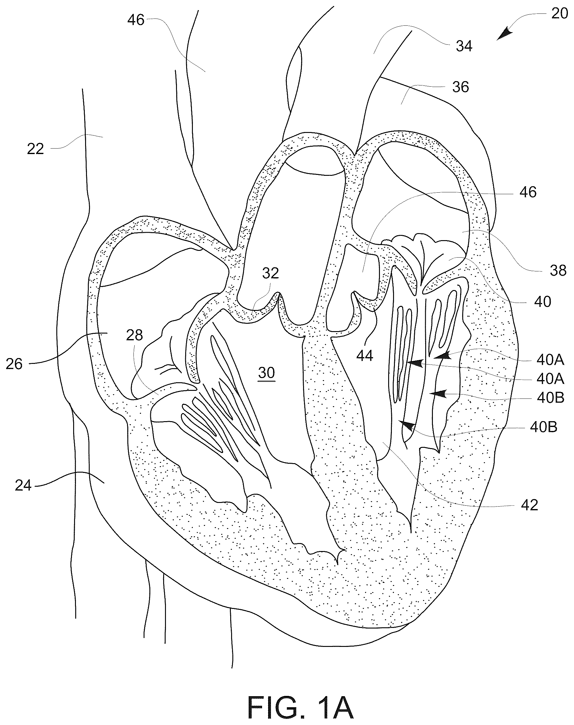 Patent US12611304 — Prosthetic incision device and methods thereof — Figure 1