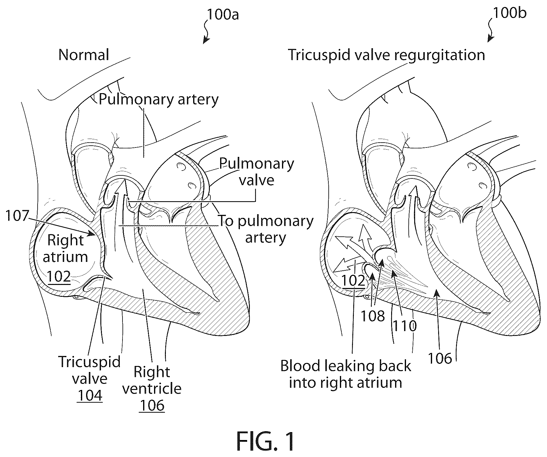 Patent US12611306 — Delivery systems and methods for prosthetic heart valve — Figure 1