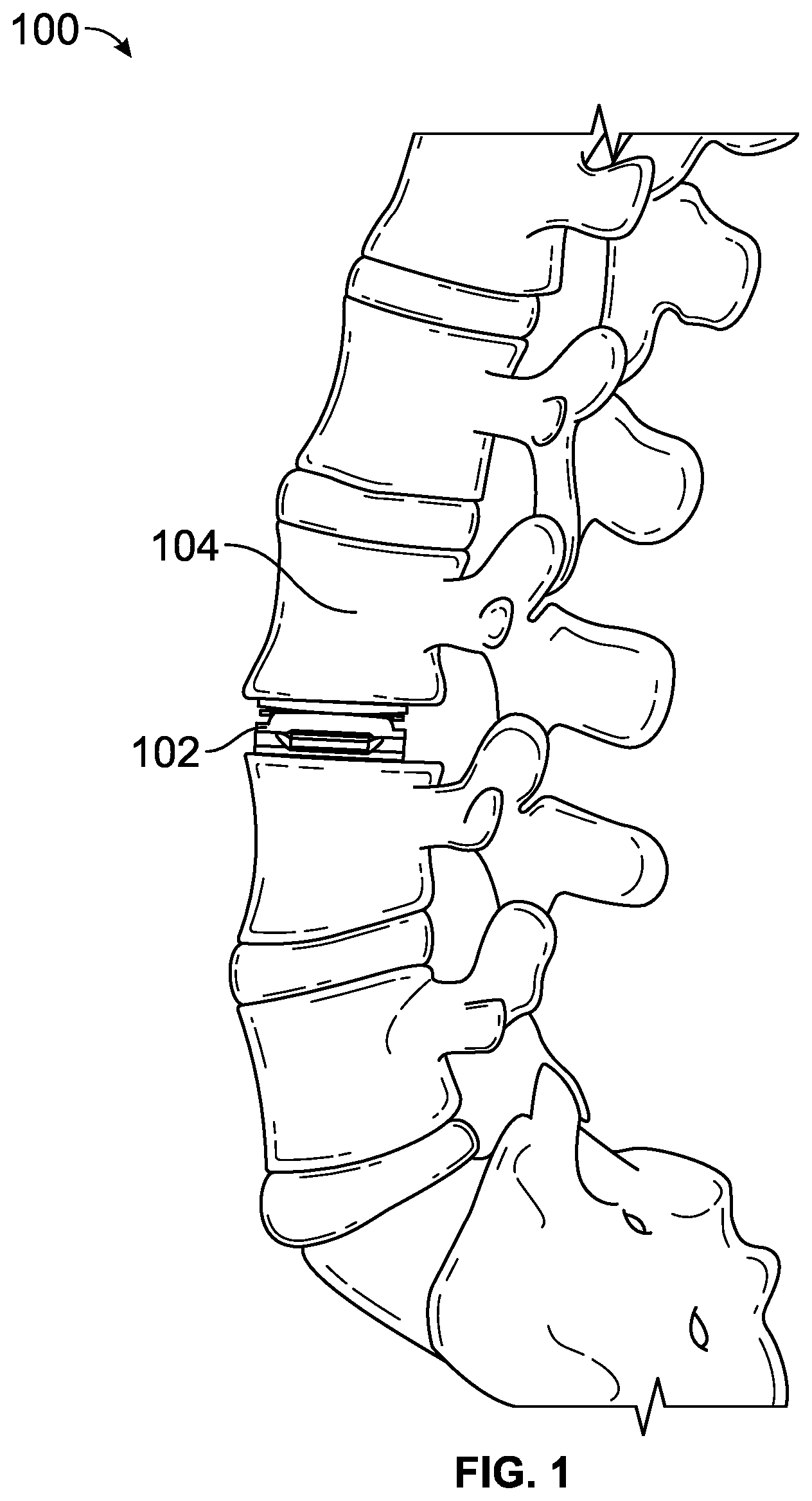 Patent US12611313 — Minimally invasive compliant devices for total lumbar disc replacement — Figure 1