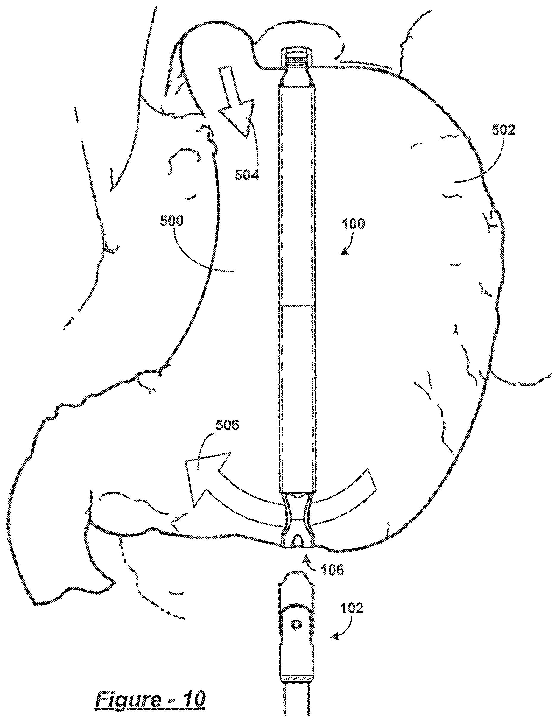 Patent US12611323 Figure 19 – Inflatable bariatric clamp