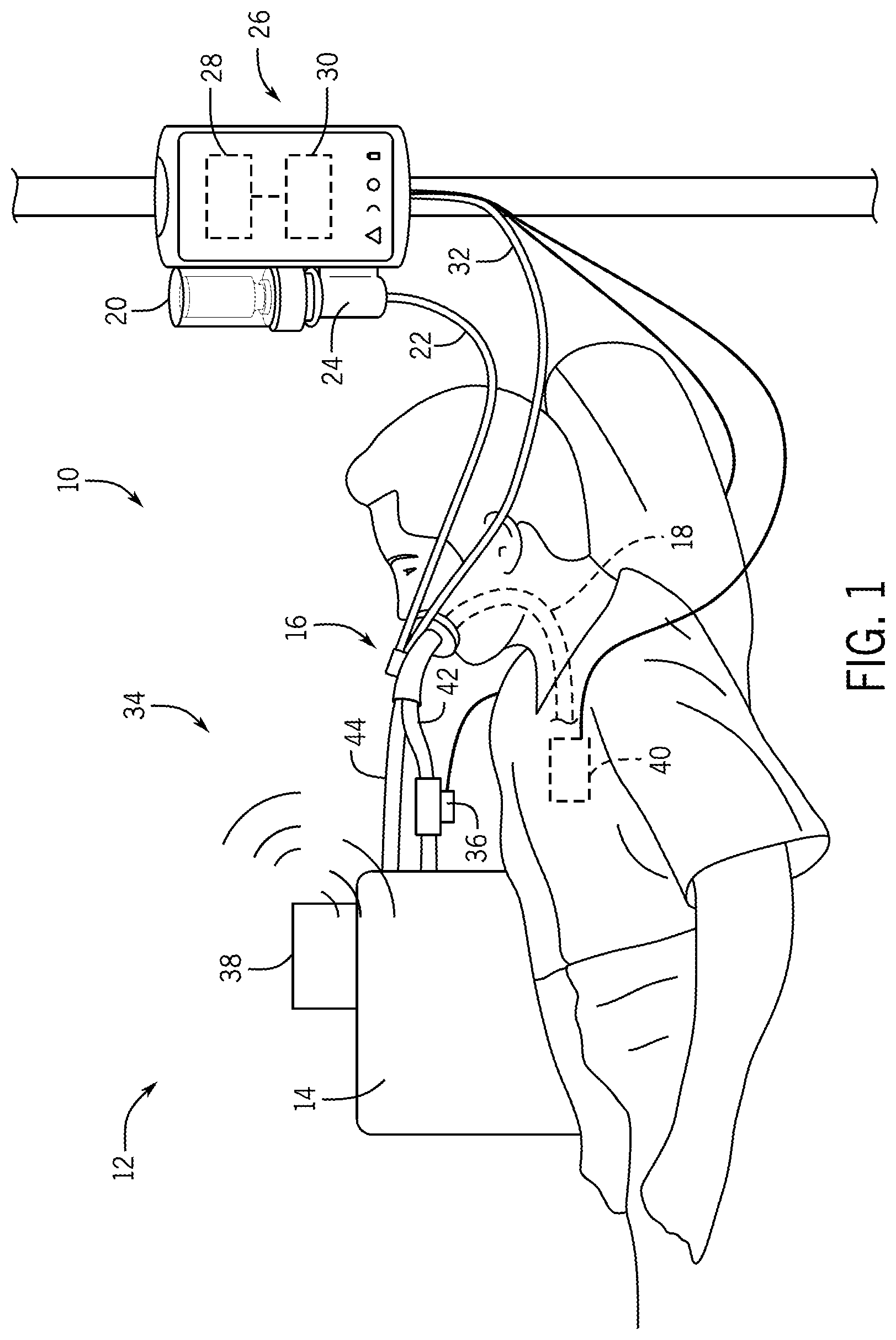 Patent US12611513 — Aerosol delivery system and method — Figure 1