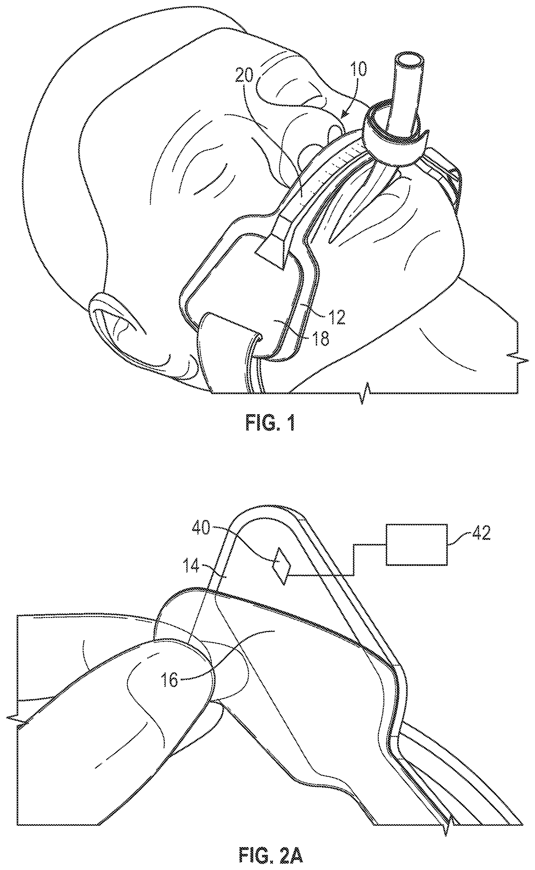 Patent US12611515 Figure 1 – Endotracheal tube holder