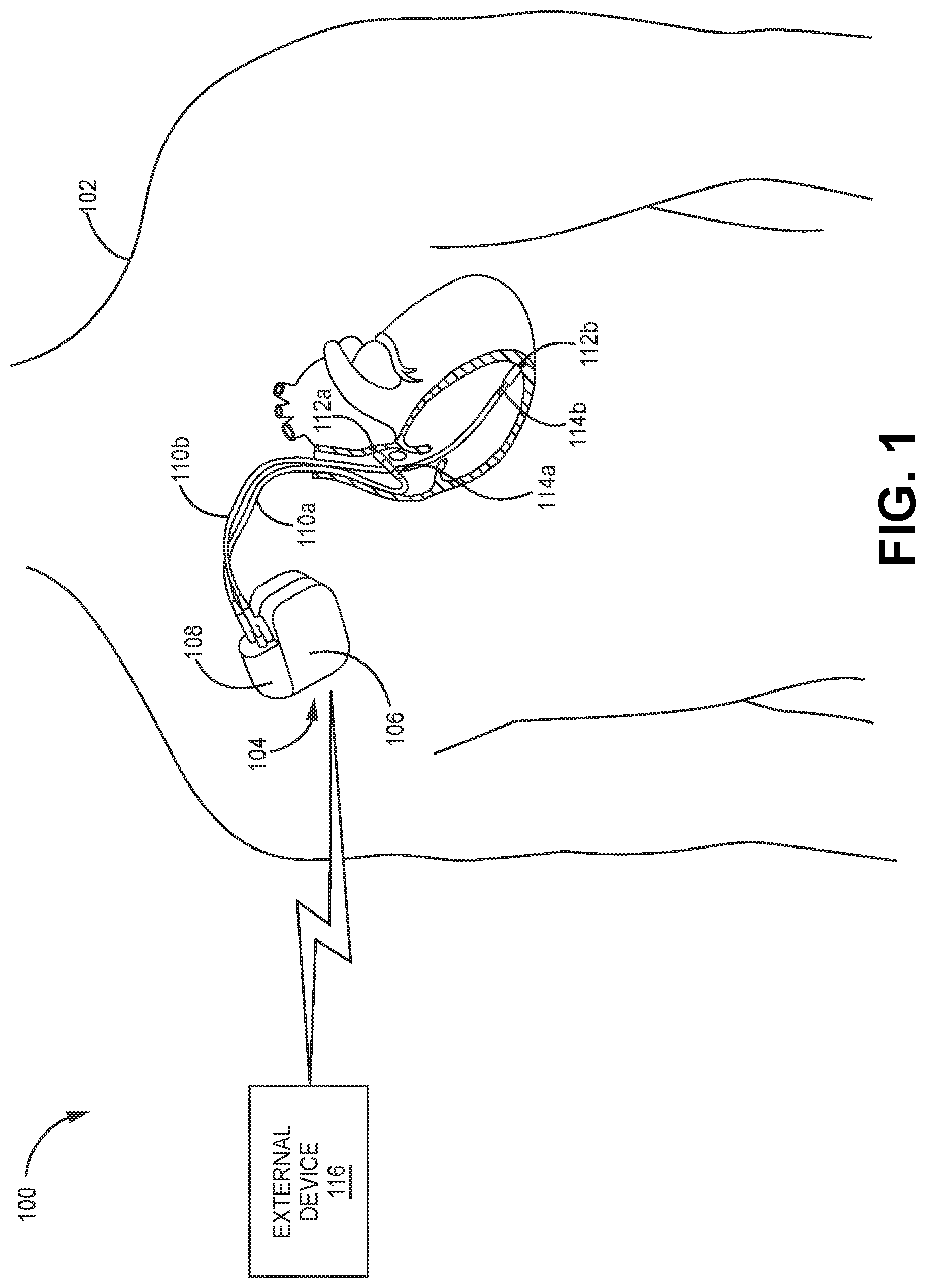 Patent US12611543 — Telemetry overuse reduction in a medical device — Figure 1