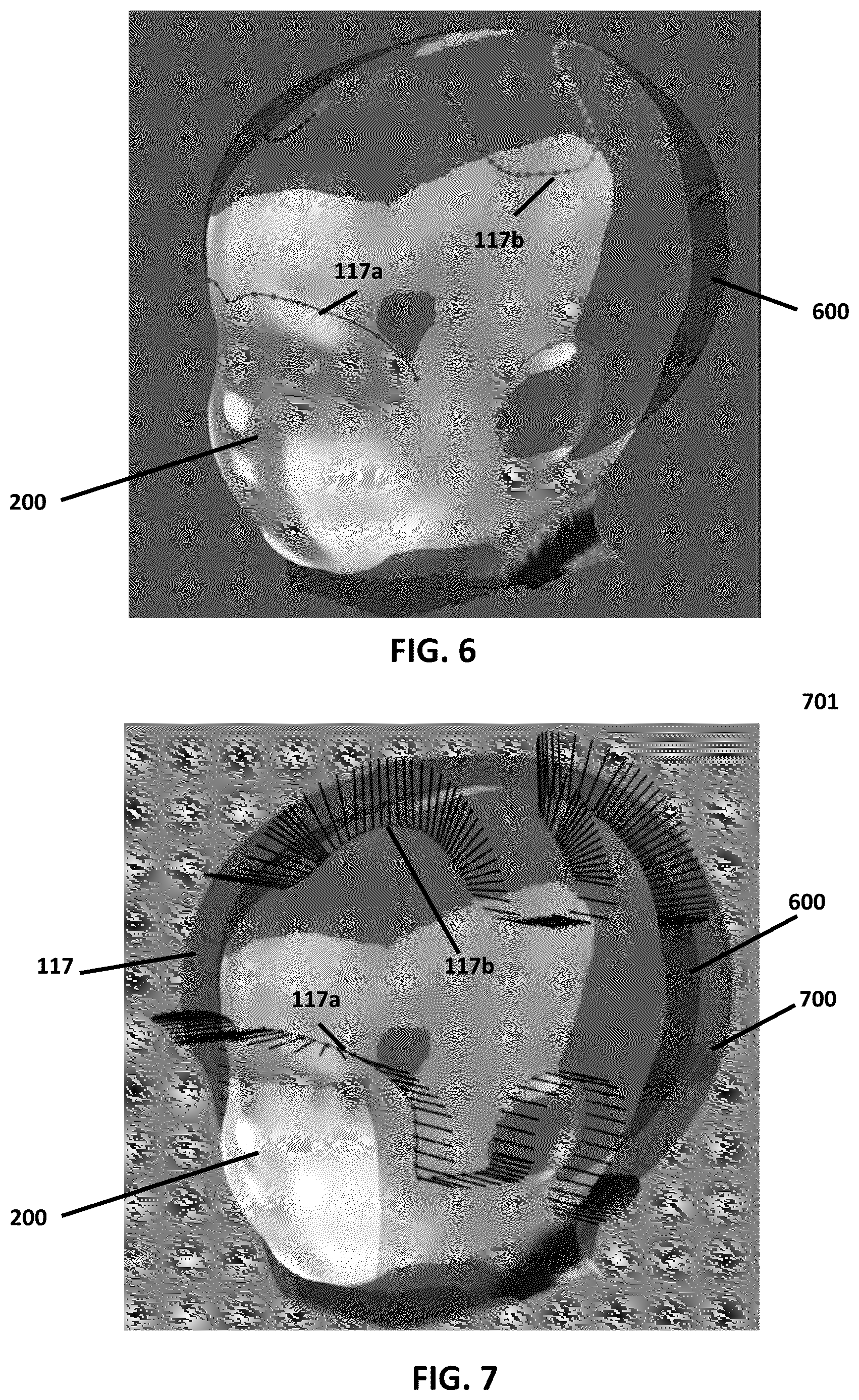 Patent US12614362 Figure 4 – Custom cranial remodeling devices manufactured by additive manufacture